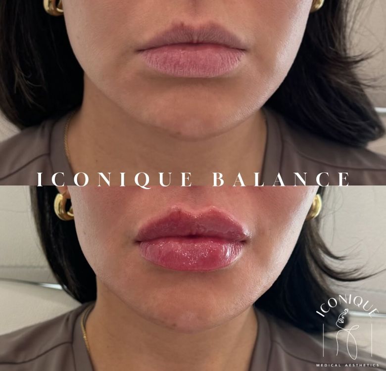 Before and after lip enhancement results.