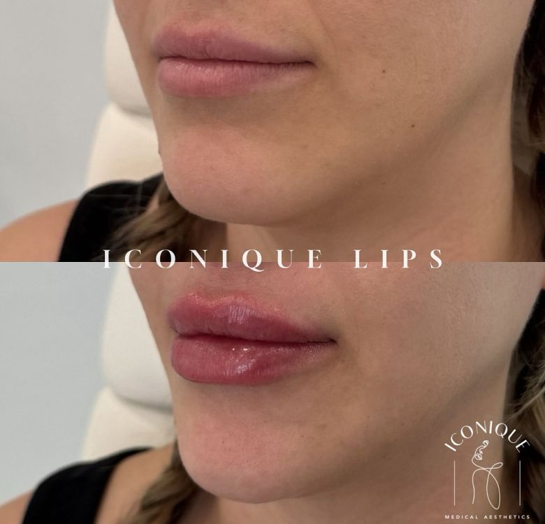 Before and after lip enhancement treatment.