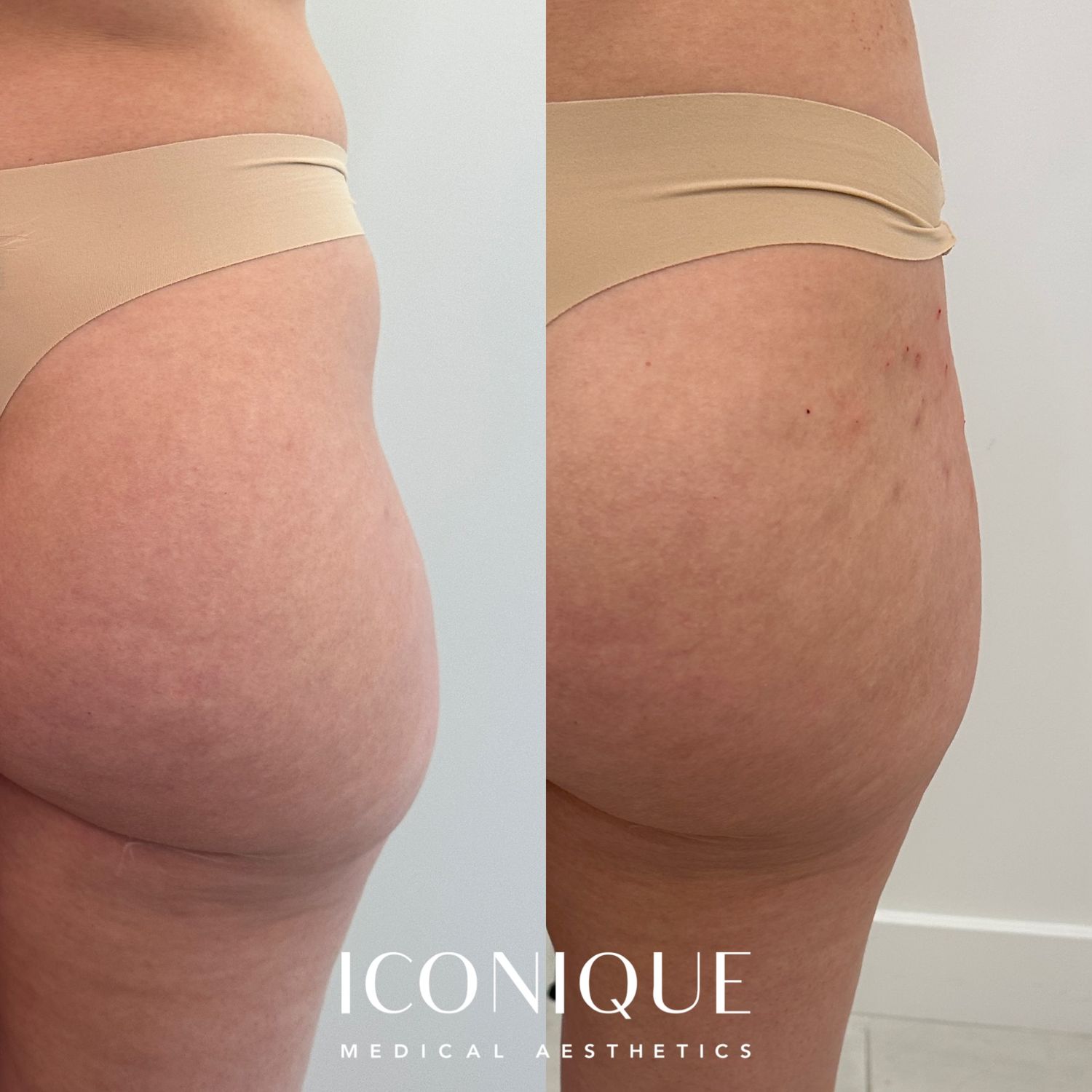 Non-surgical BBL Before & After