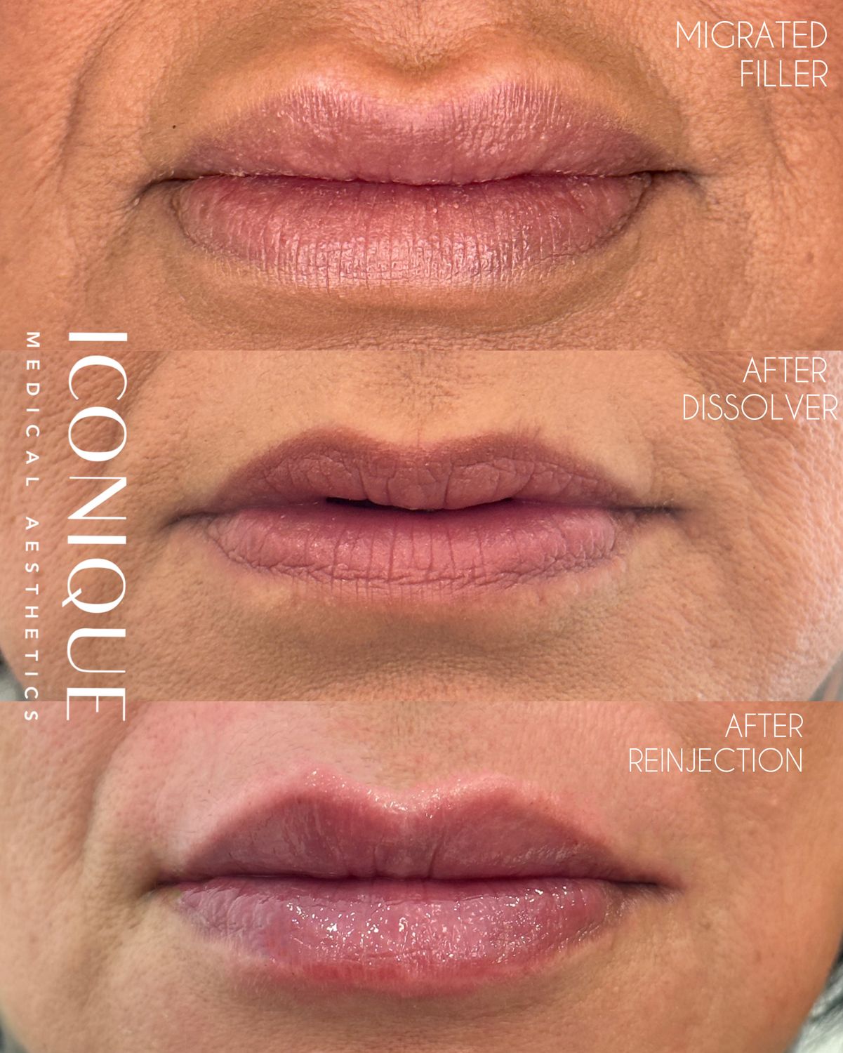 Lip Reset Before & After