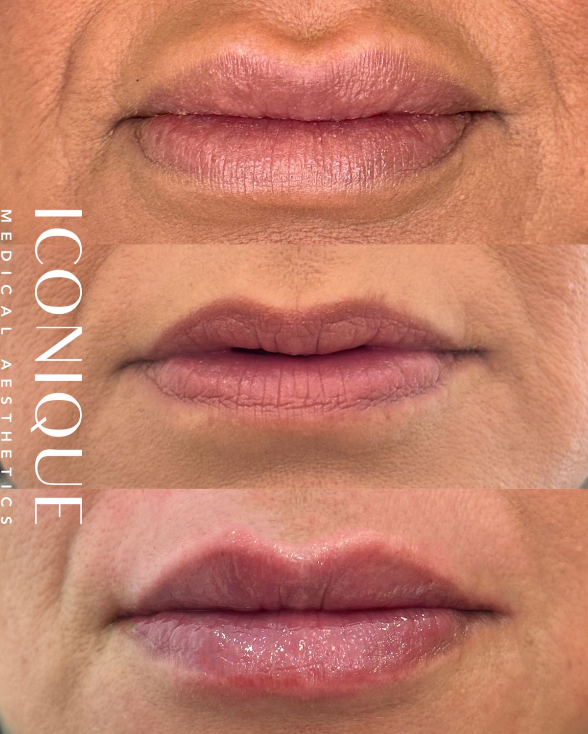 Lip Reset Before & After