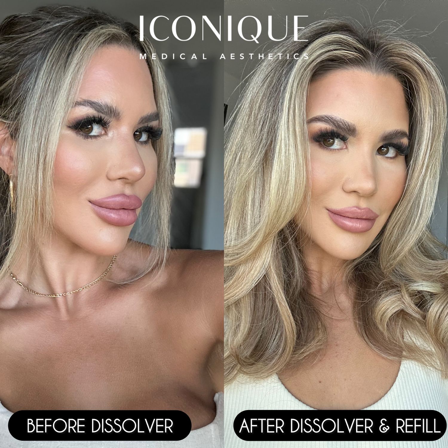 Lip Reset Before & After