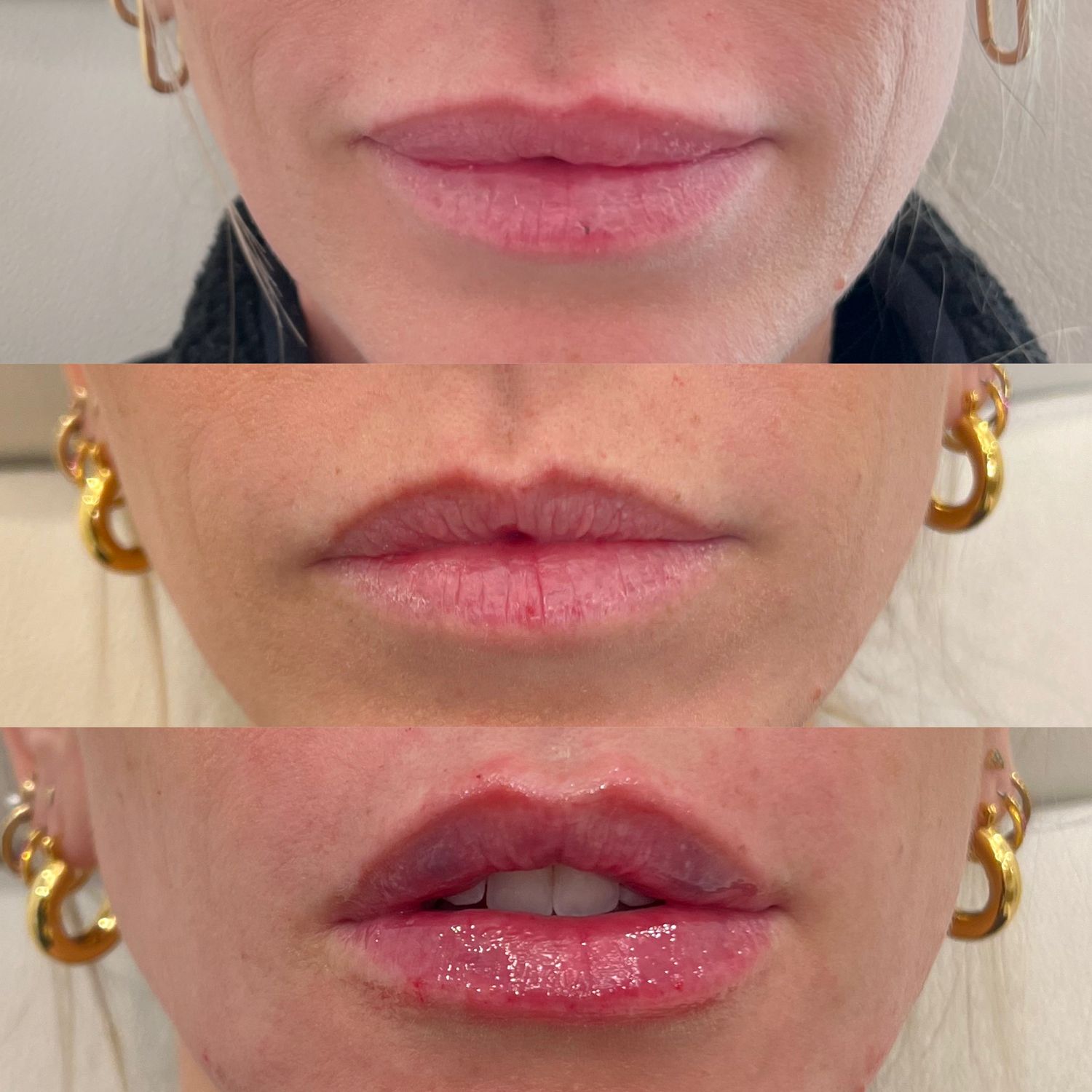 Lip Reset Before & After