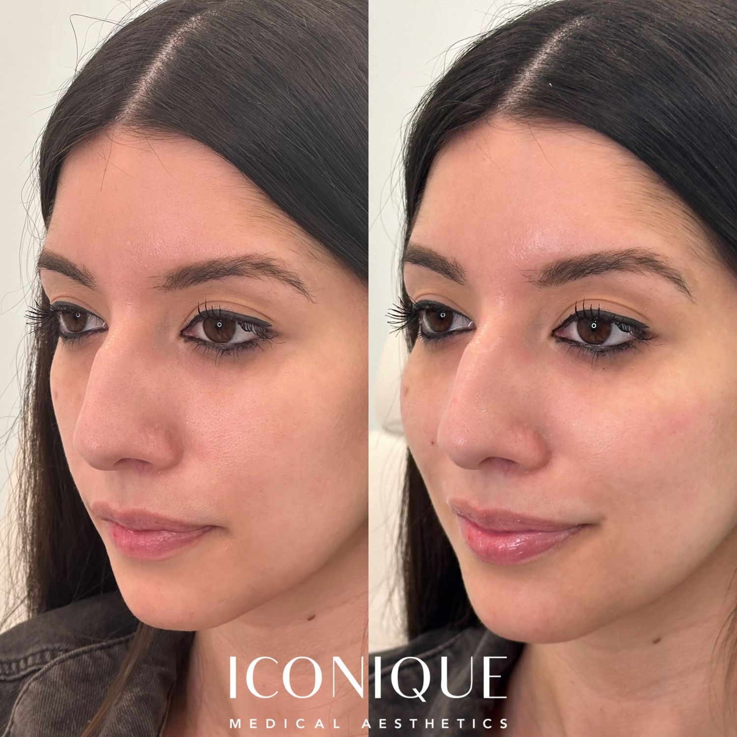 Cheek Filler Before & After
