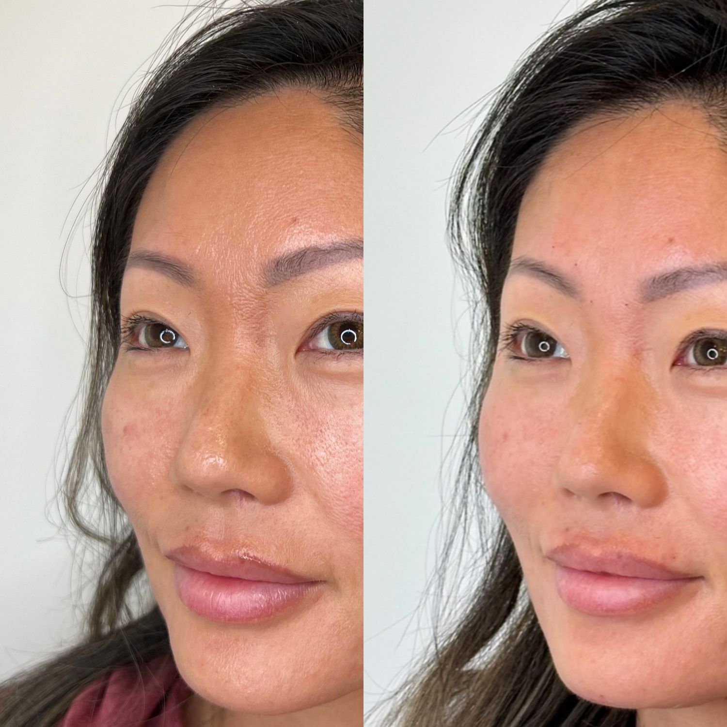Cheek Filler Before & After