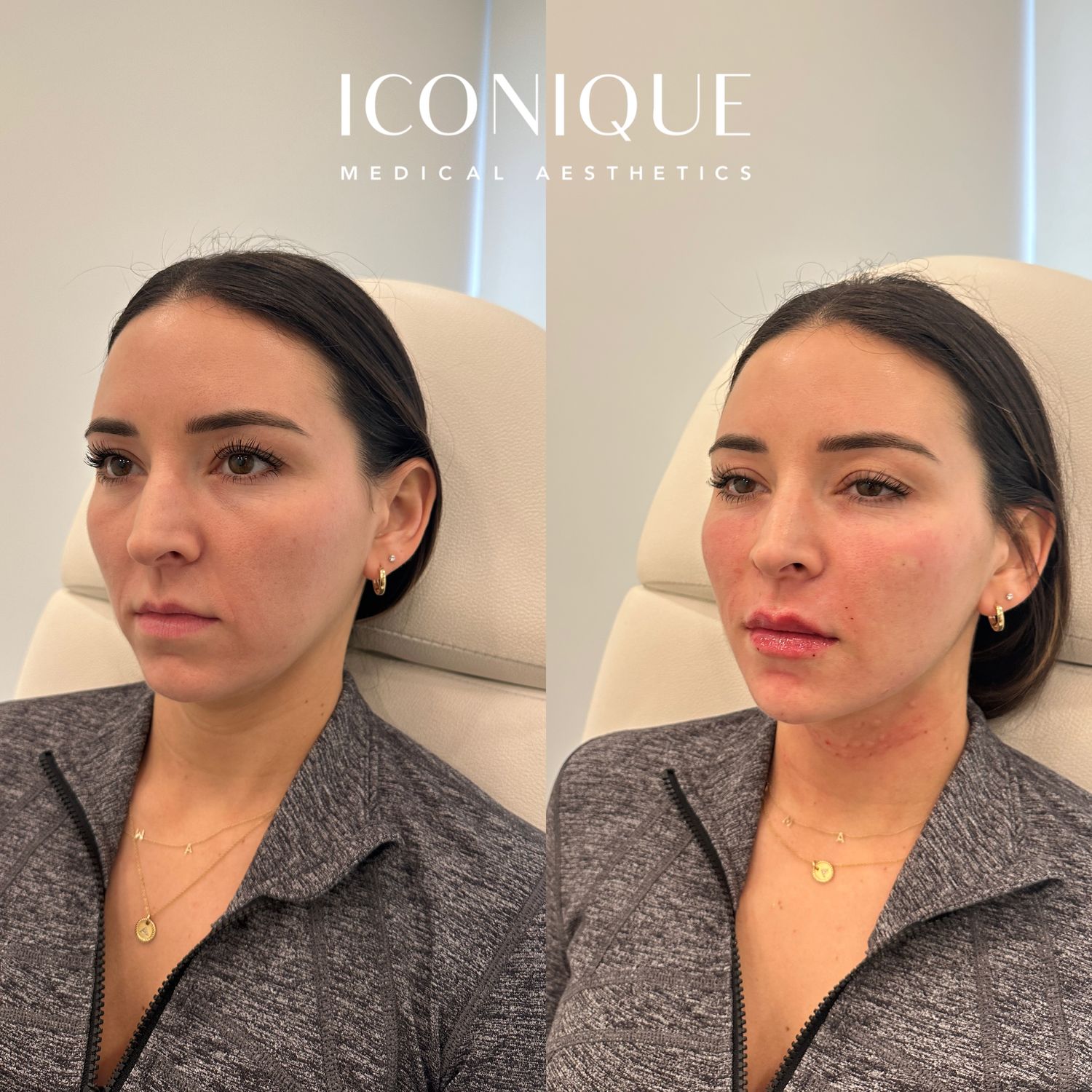 Facial Balancing Before & After