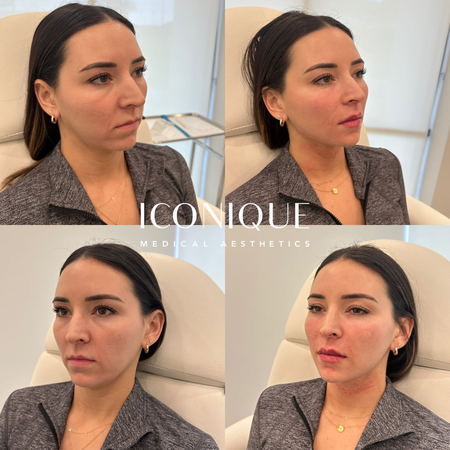 Facial Balancing Before & After