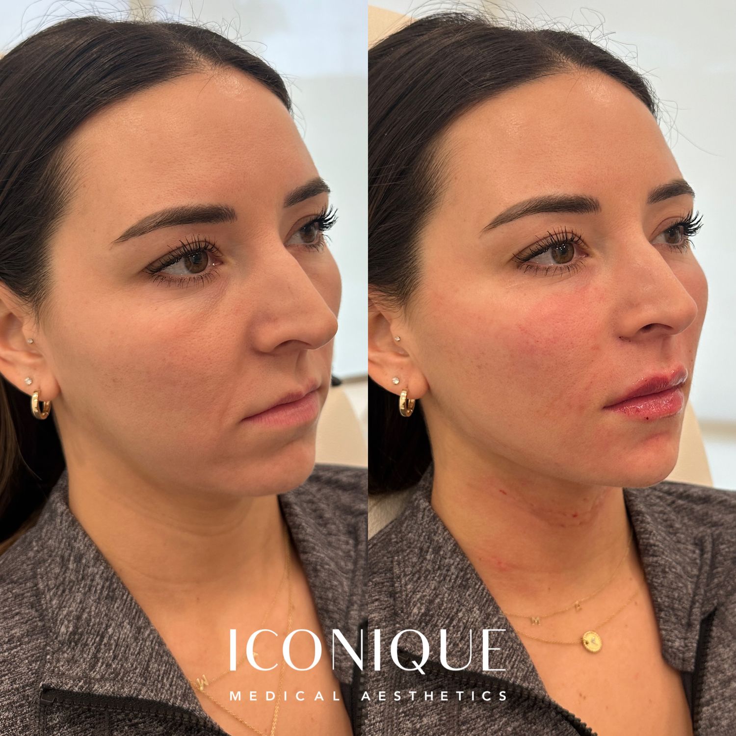 Facial Balancing Before & After