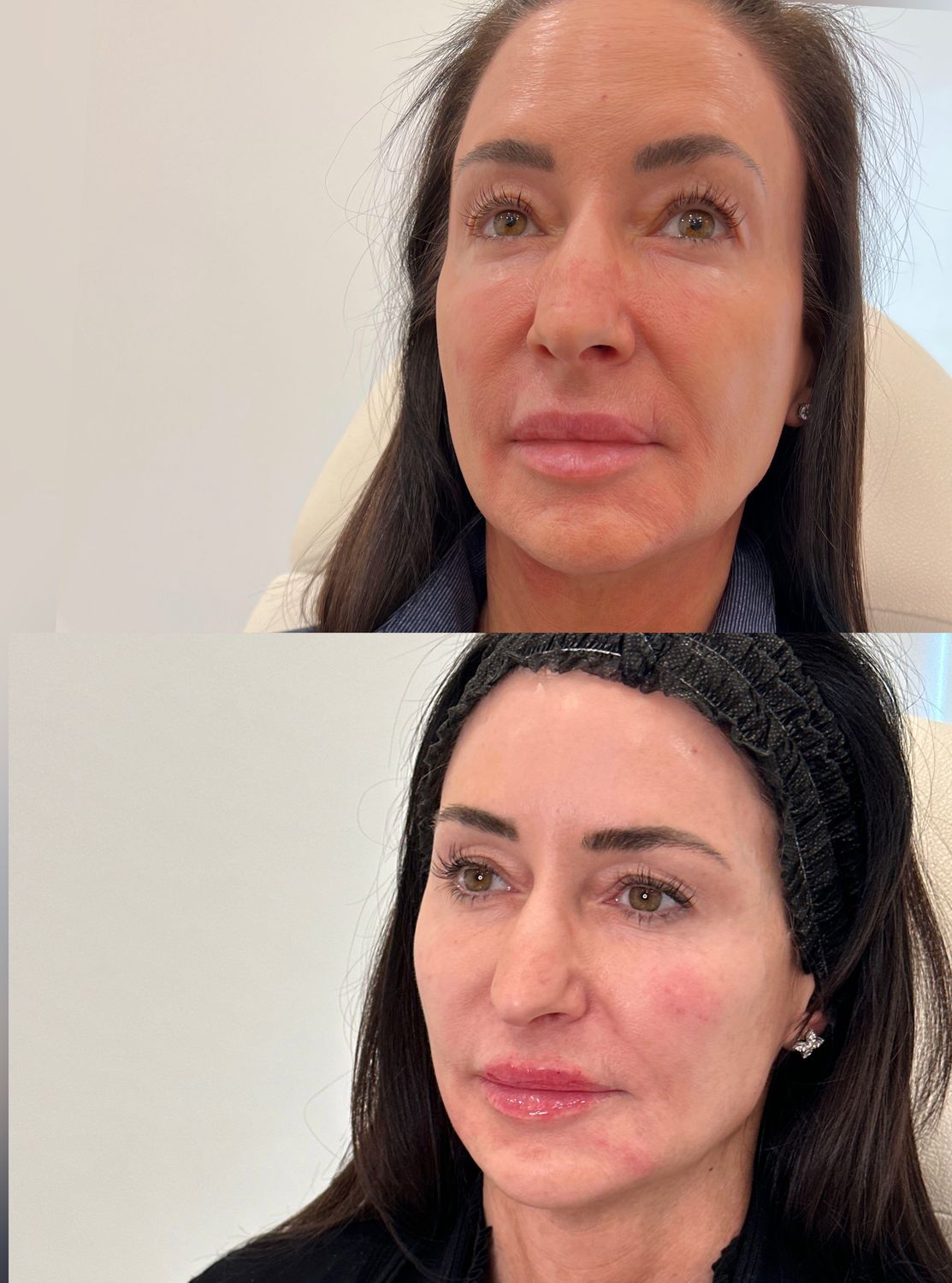 Facial Balancing Before & After
