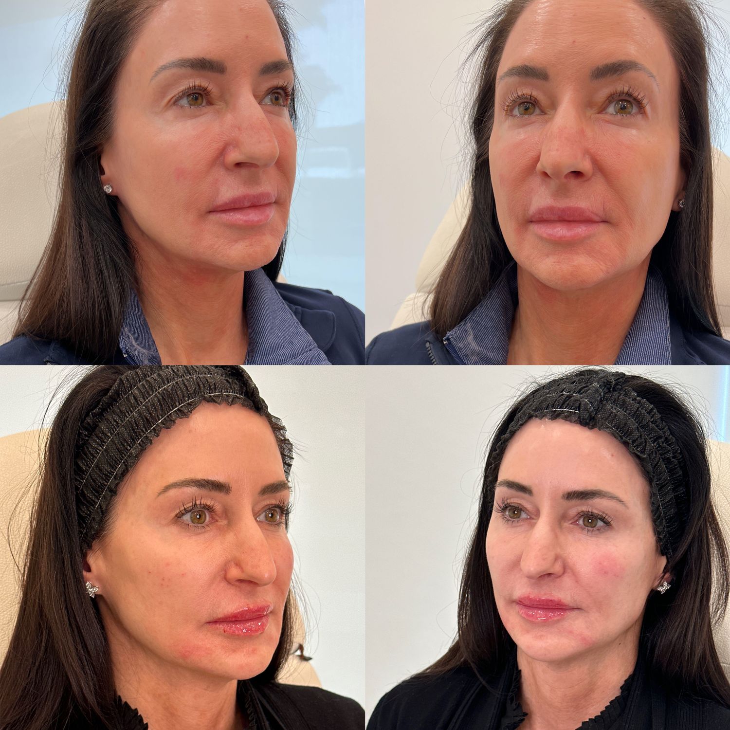 Facial Balancing Before & After