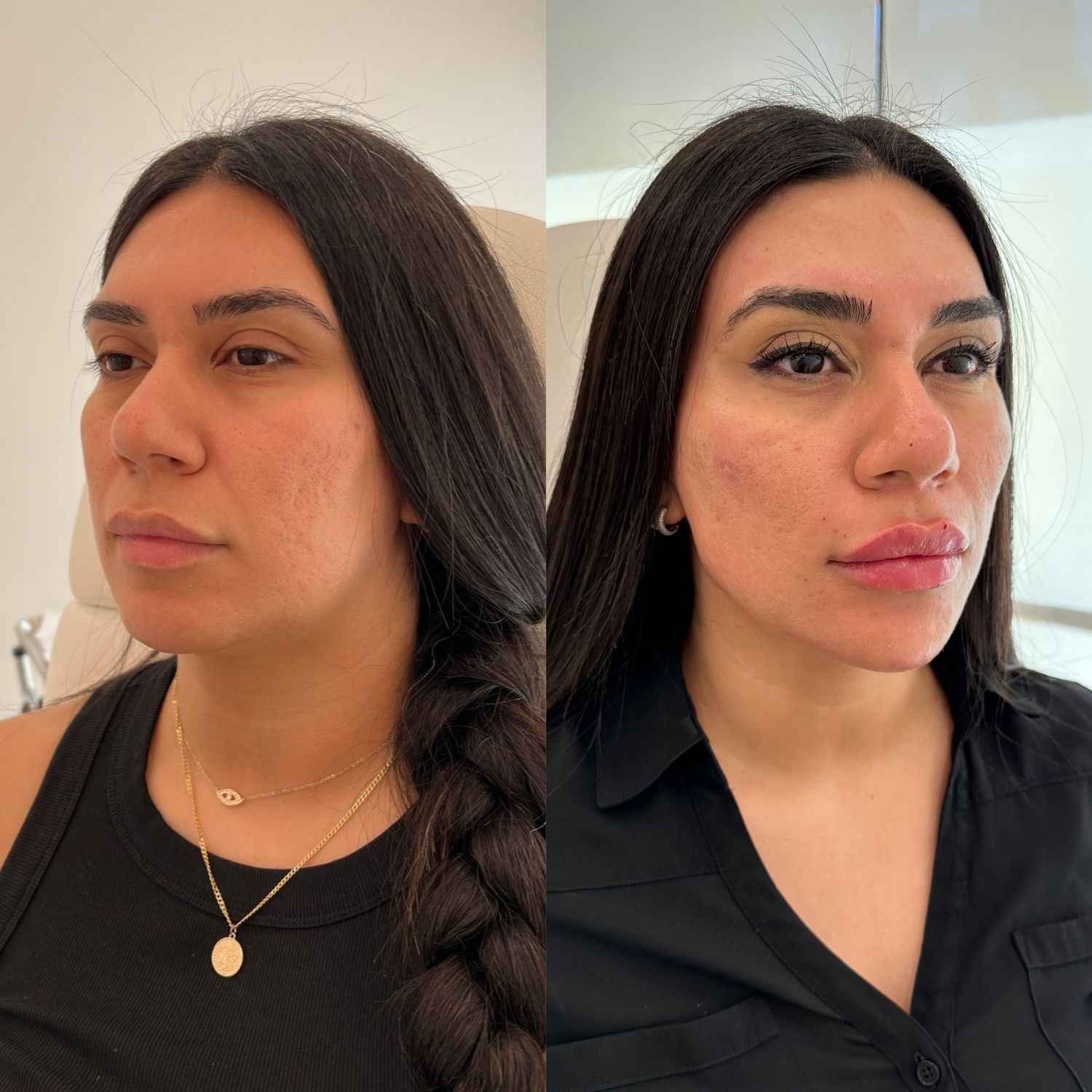 Facial Balancing Before & After