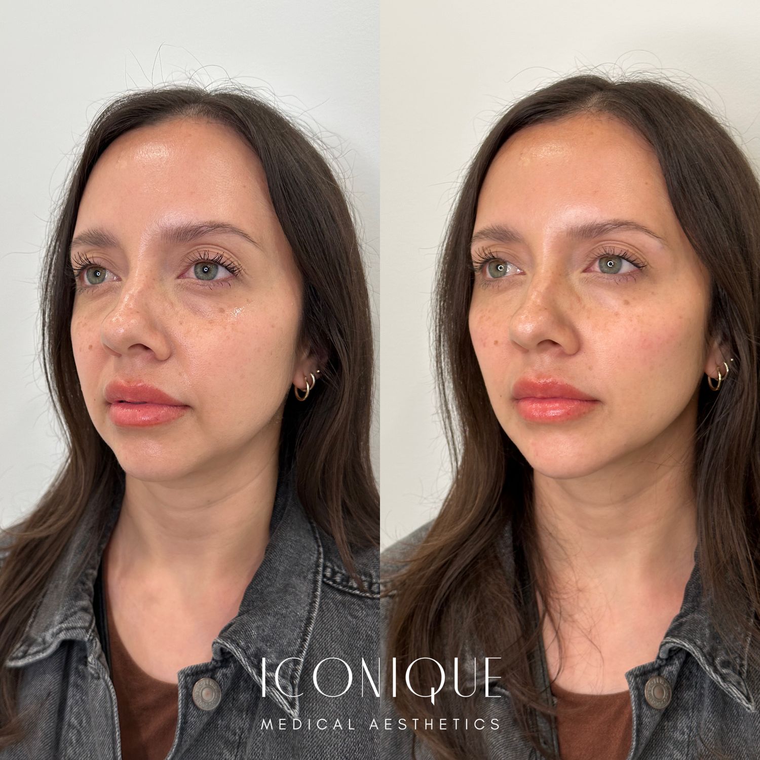 Facial Balancing Before & After