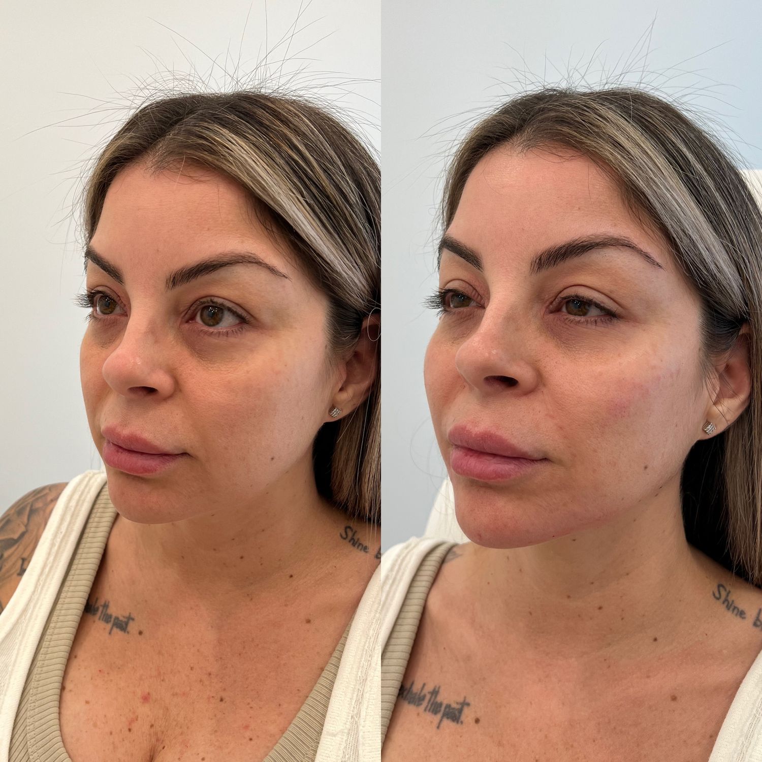 Facial Balancing Before & After