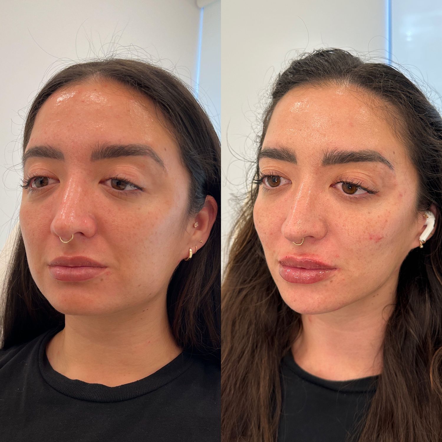 Facial Balancing Before & After