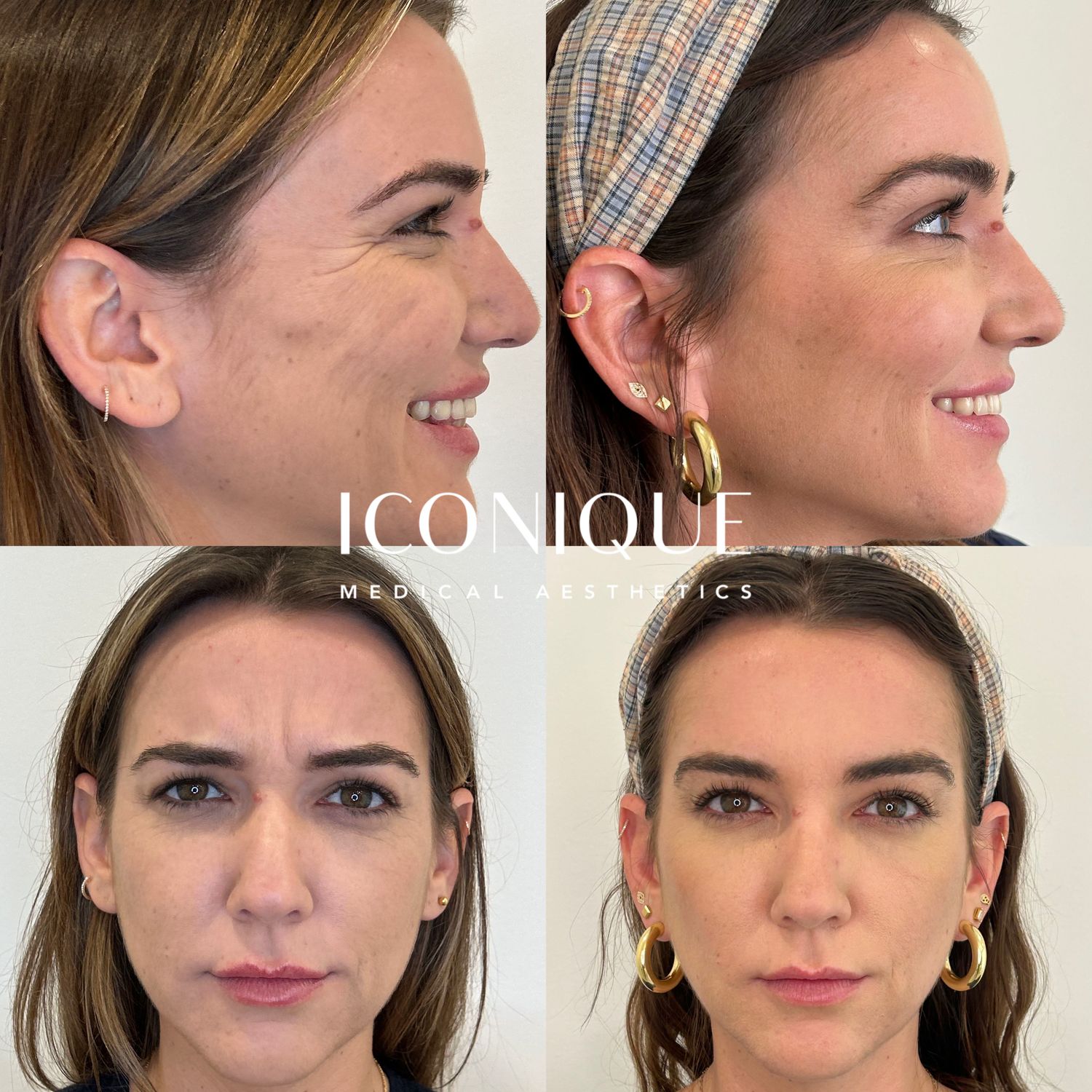 Botox Before & After