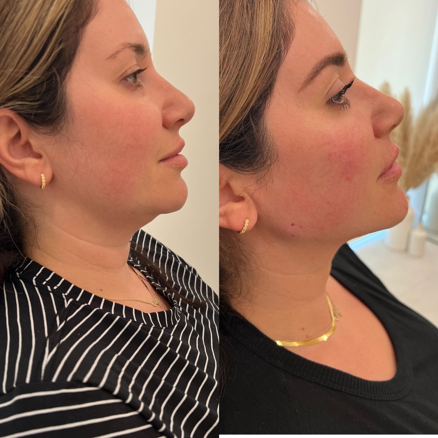 Kybella Before & After