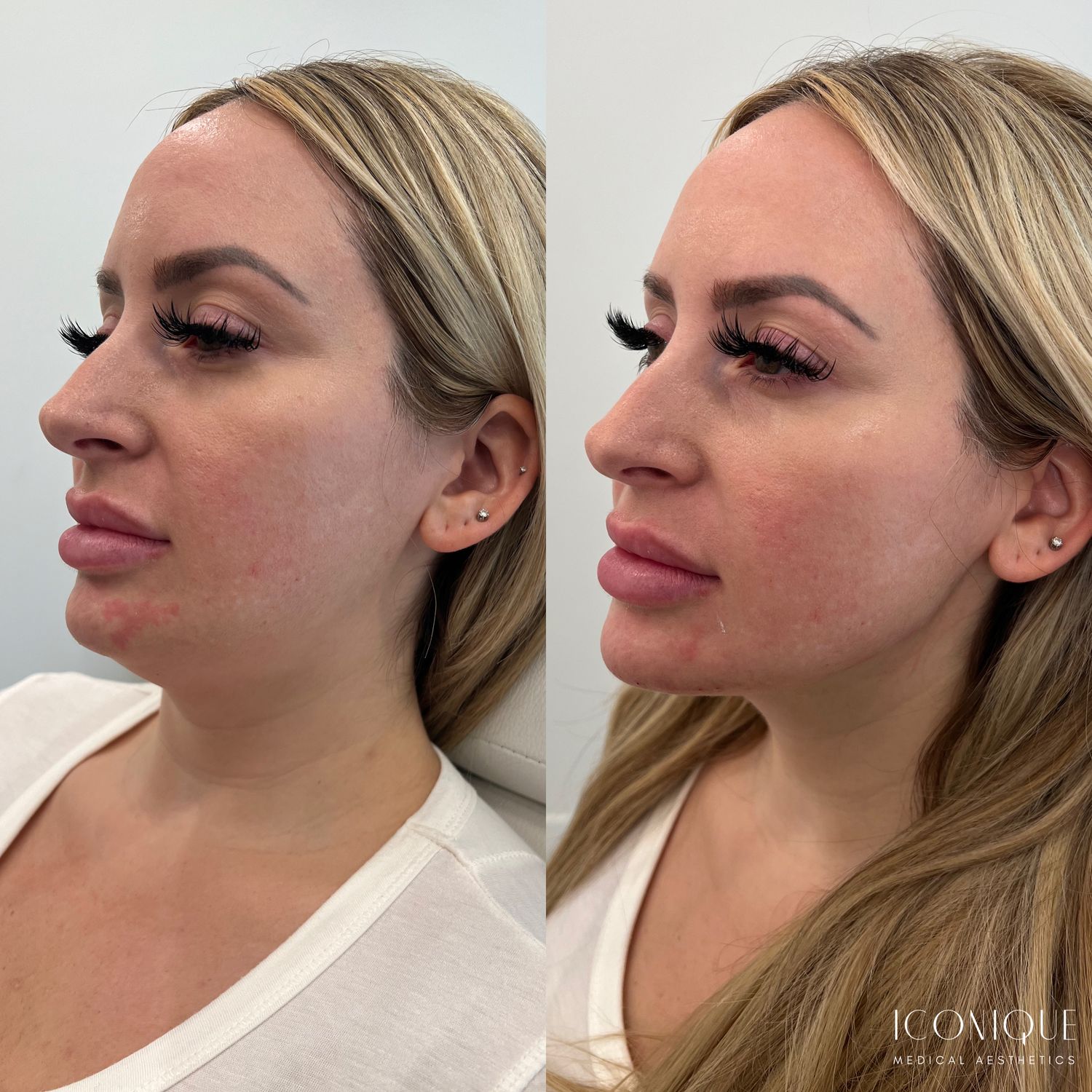 Kybella Before & After
