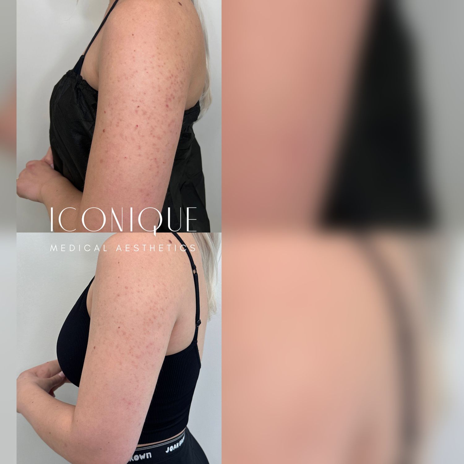 Kybella Before & After