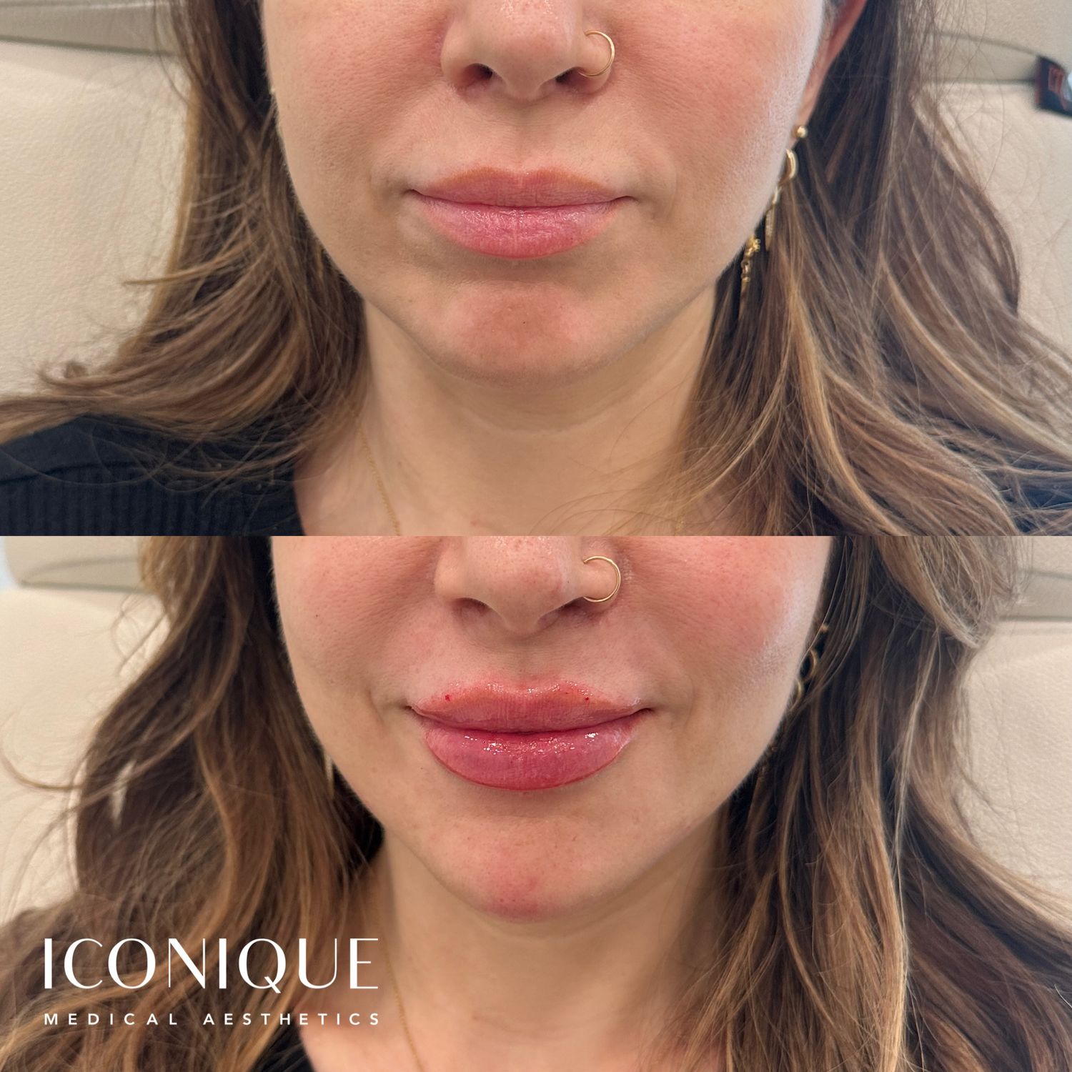 Lips + Chin Filler Before & After