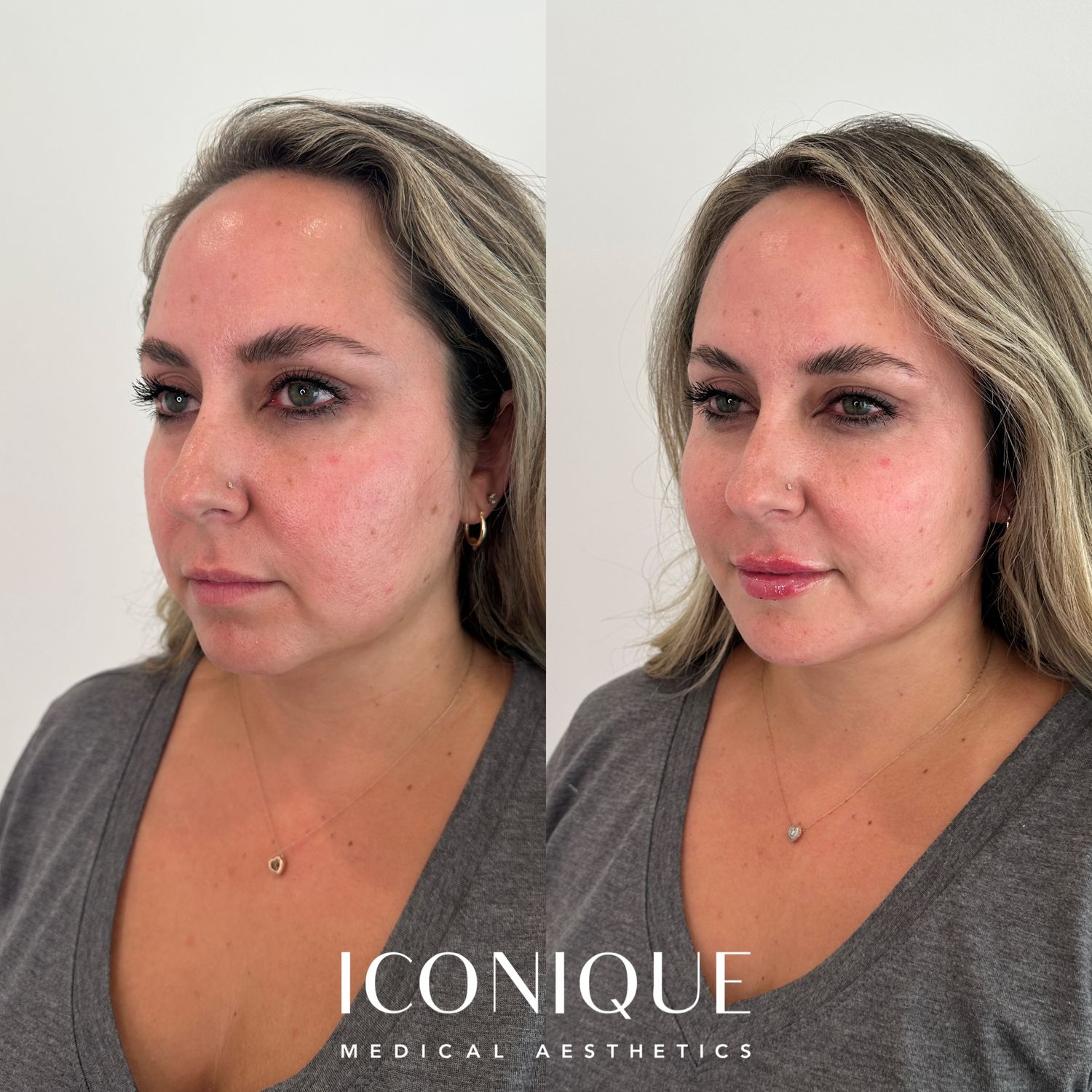 Lips + Chin Filler Before & After