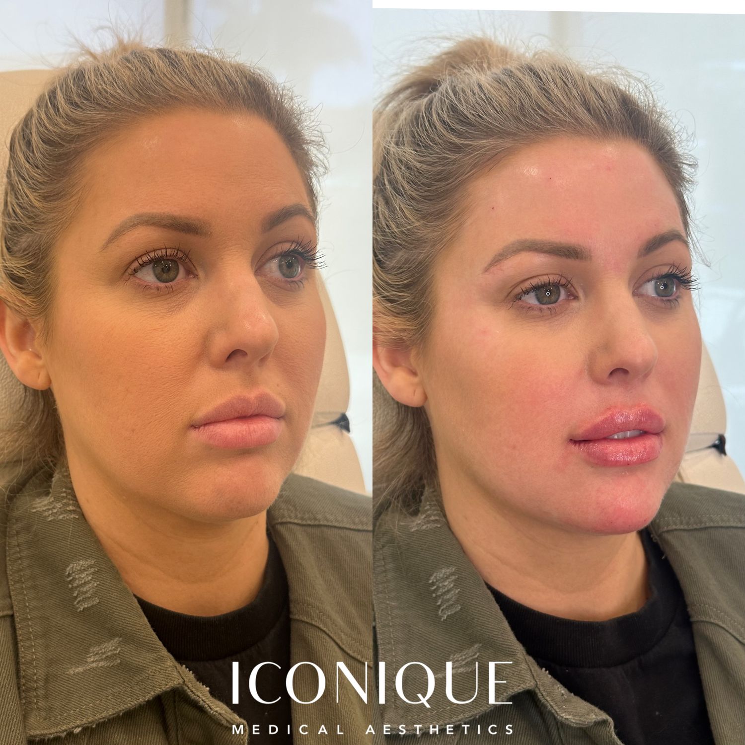 Lips + Chin Filler Before & After