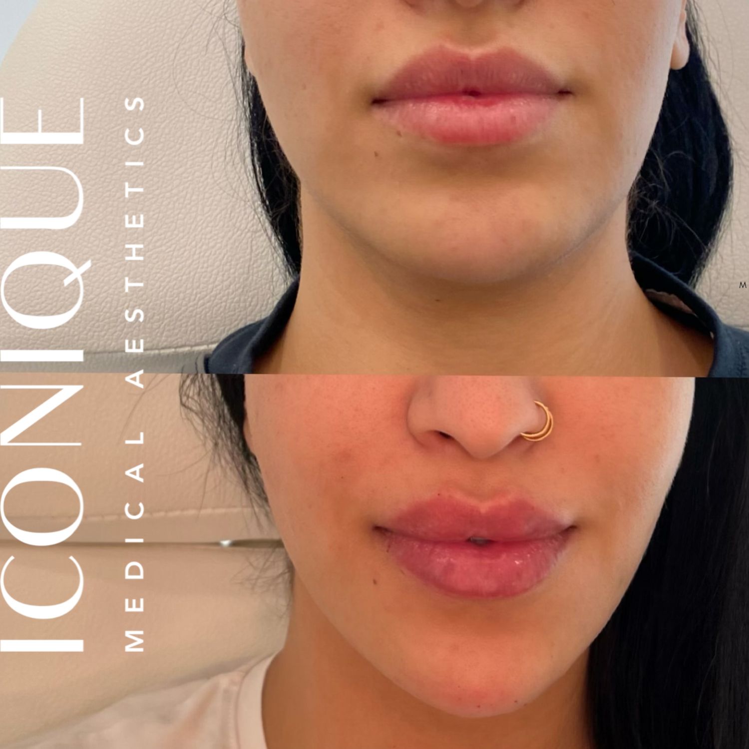 Lips + Chin Filler Before & After