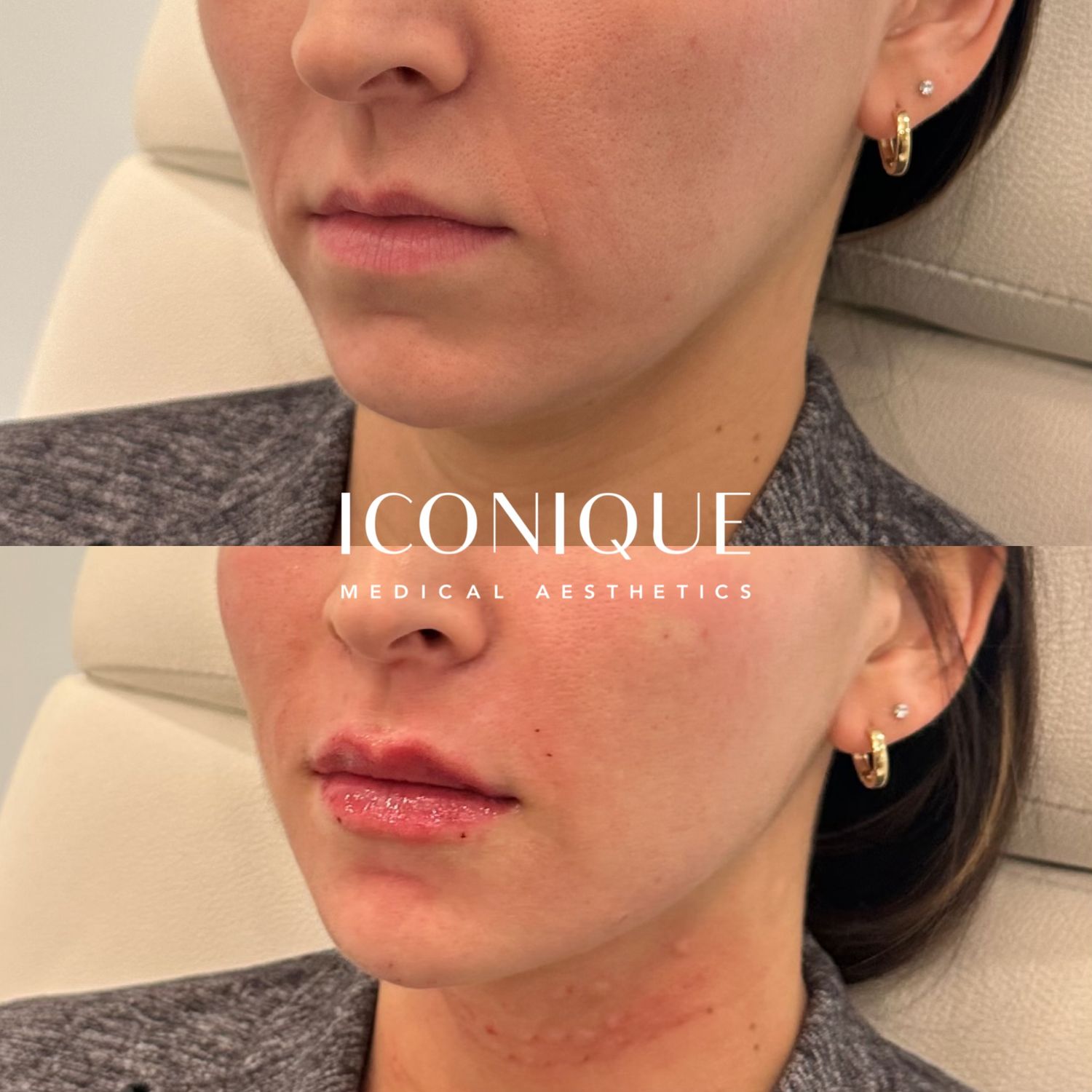 Lips + Chin Filler Before & After