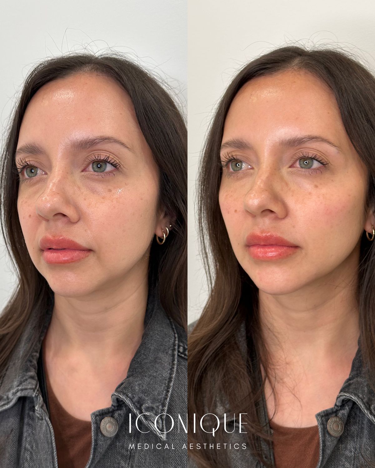 Lips + Chin Filler Before & After