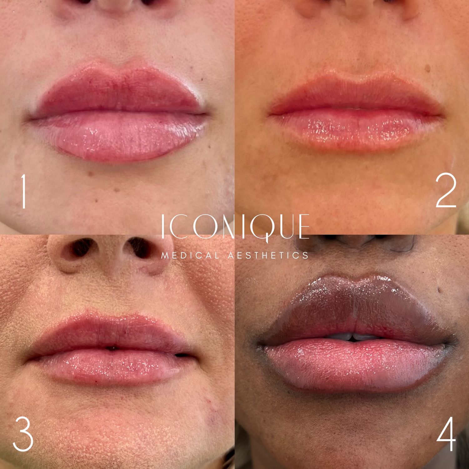 Lip Filler Before & After