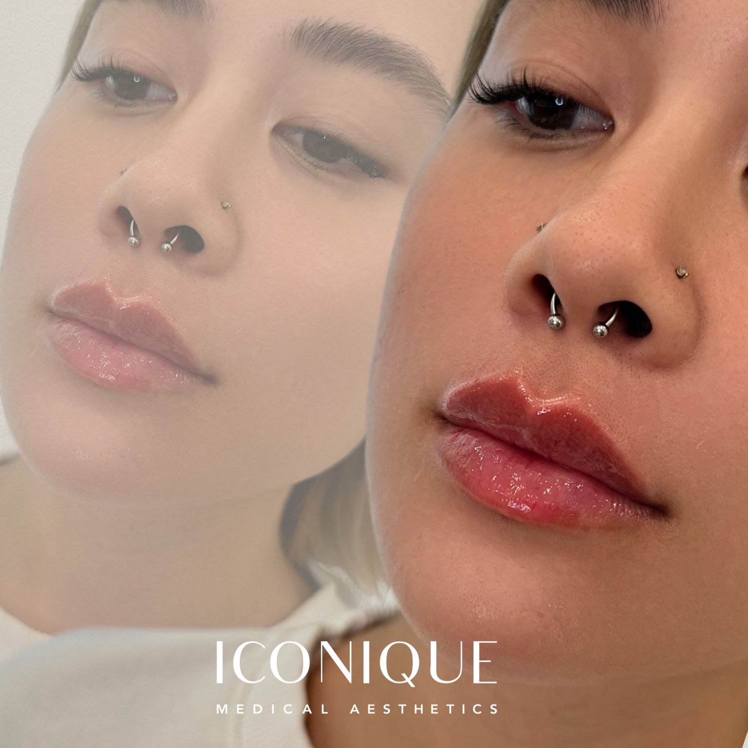 Lip Filler Before & After