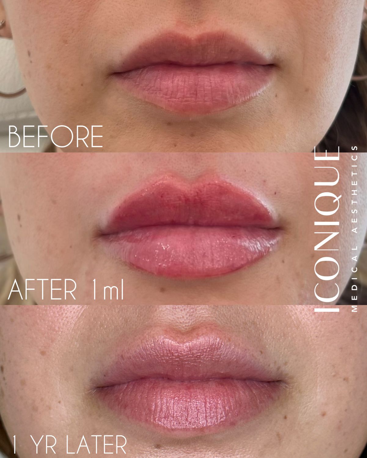 Lip Filler Before & After