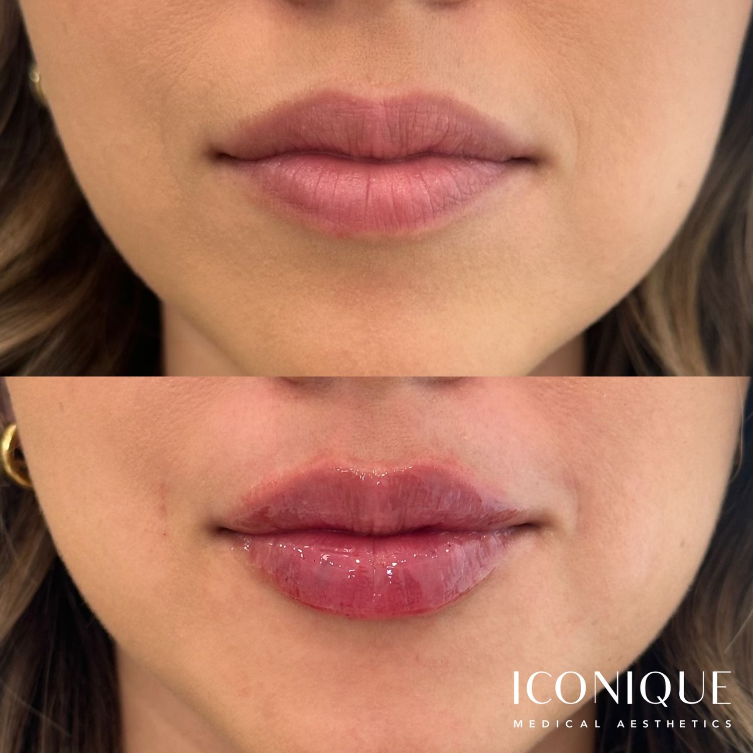 Lip Filler Before & After