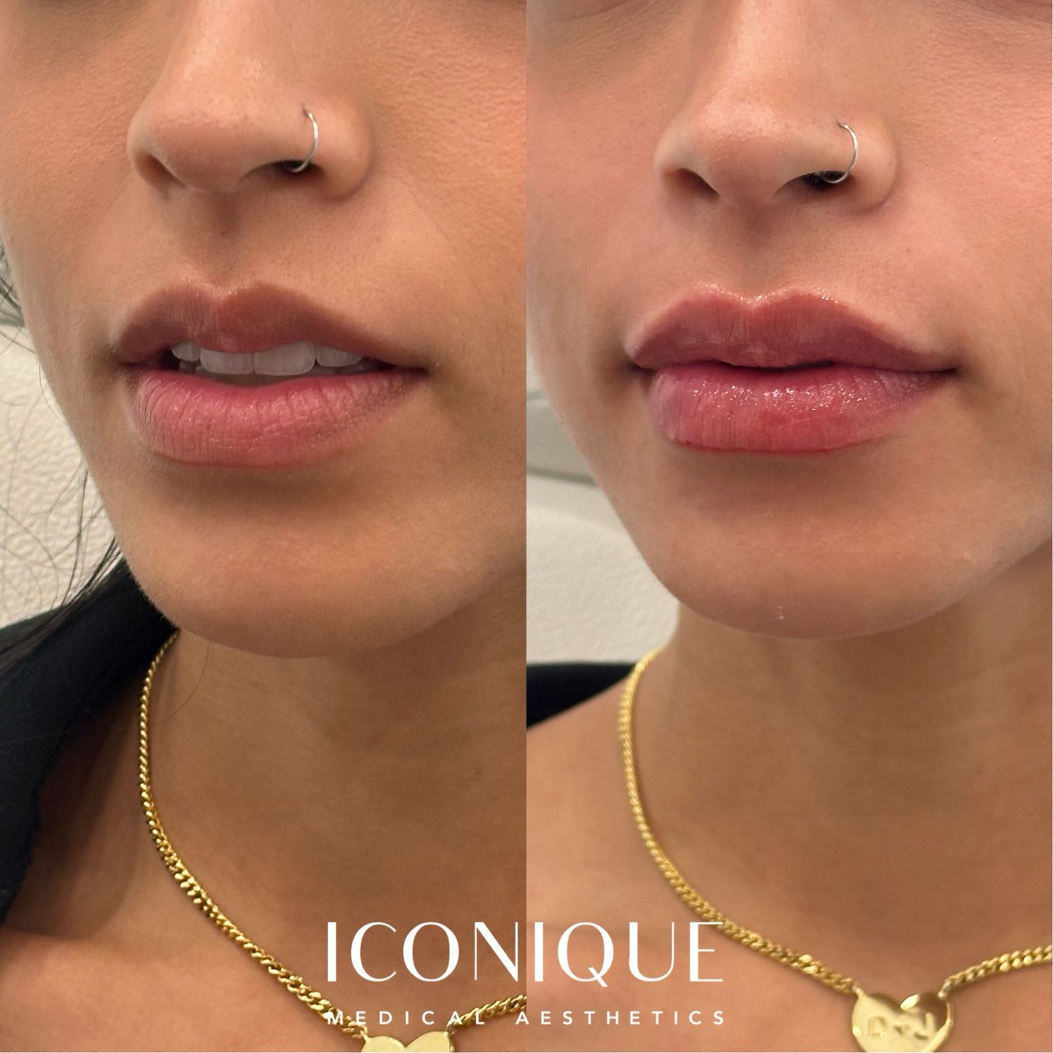 Lip Filler Before & After
