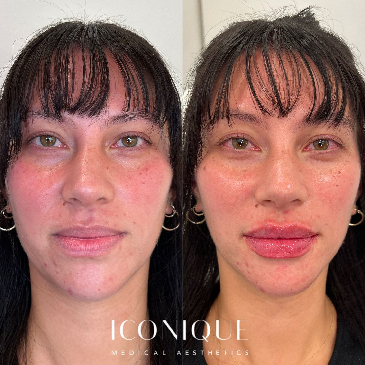 Lip Filler Before & After