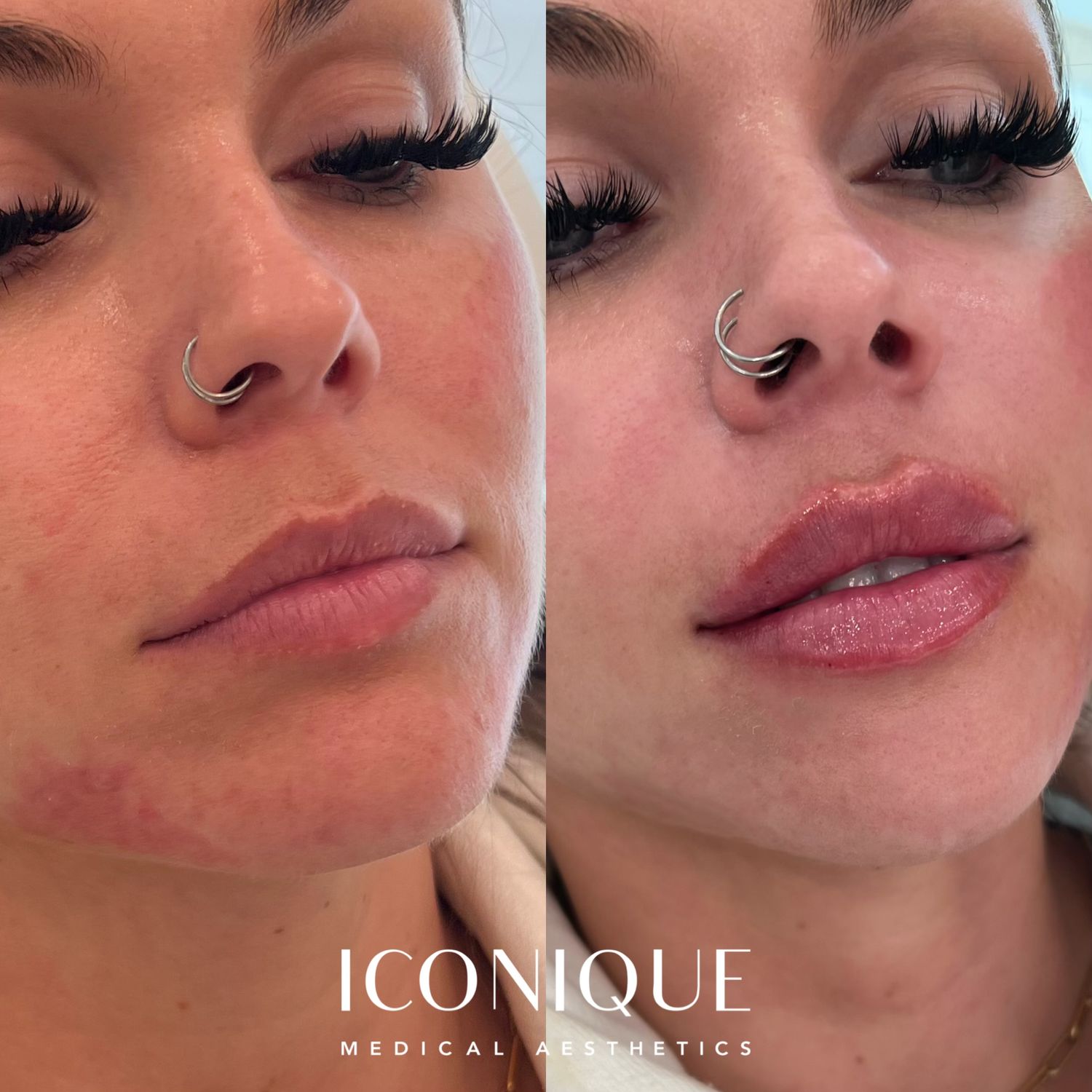 Lip Filler Before & After