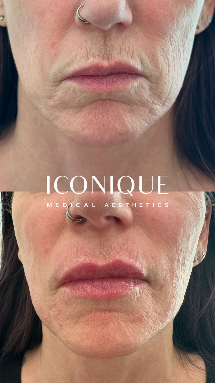 Lip Filler Before & After