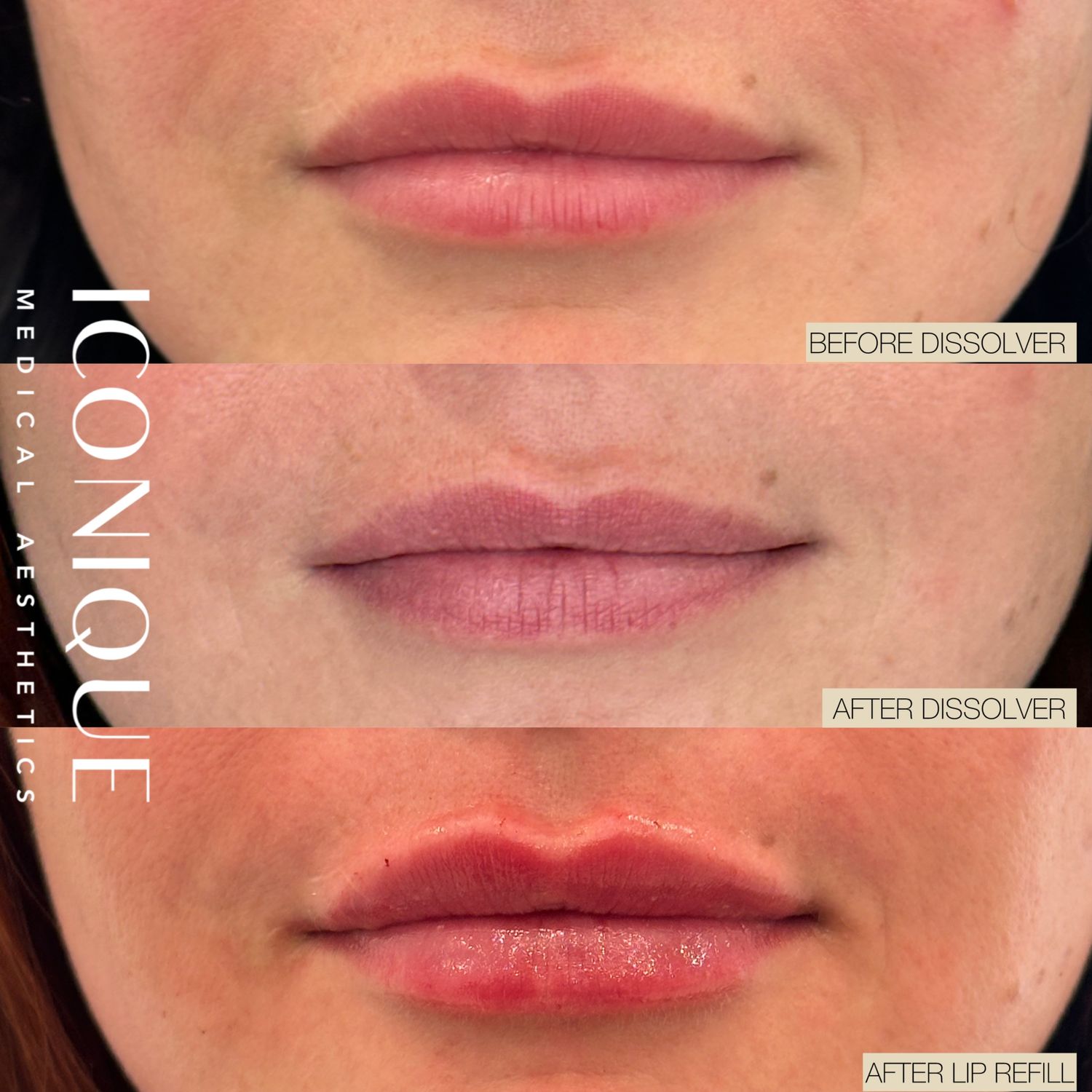 Lip Filler Before & After