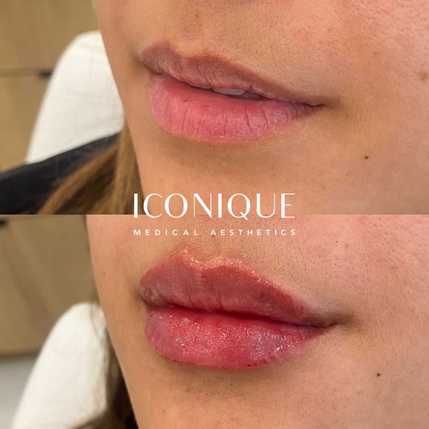 Lip Filler Before & After