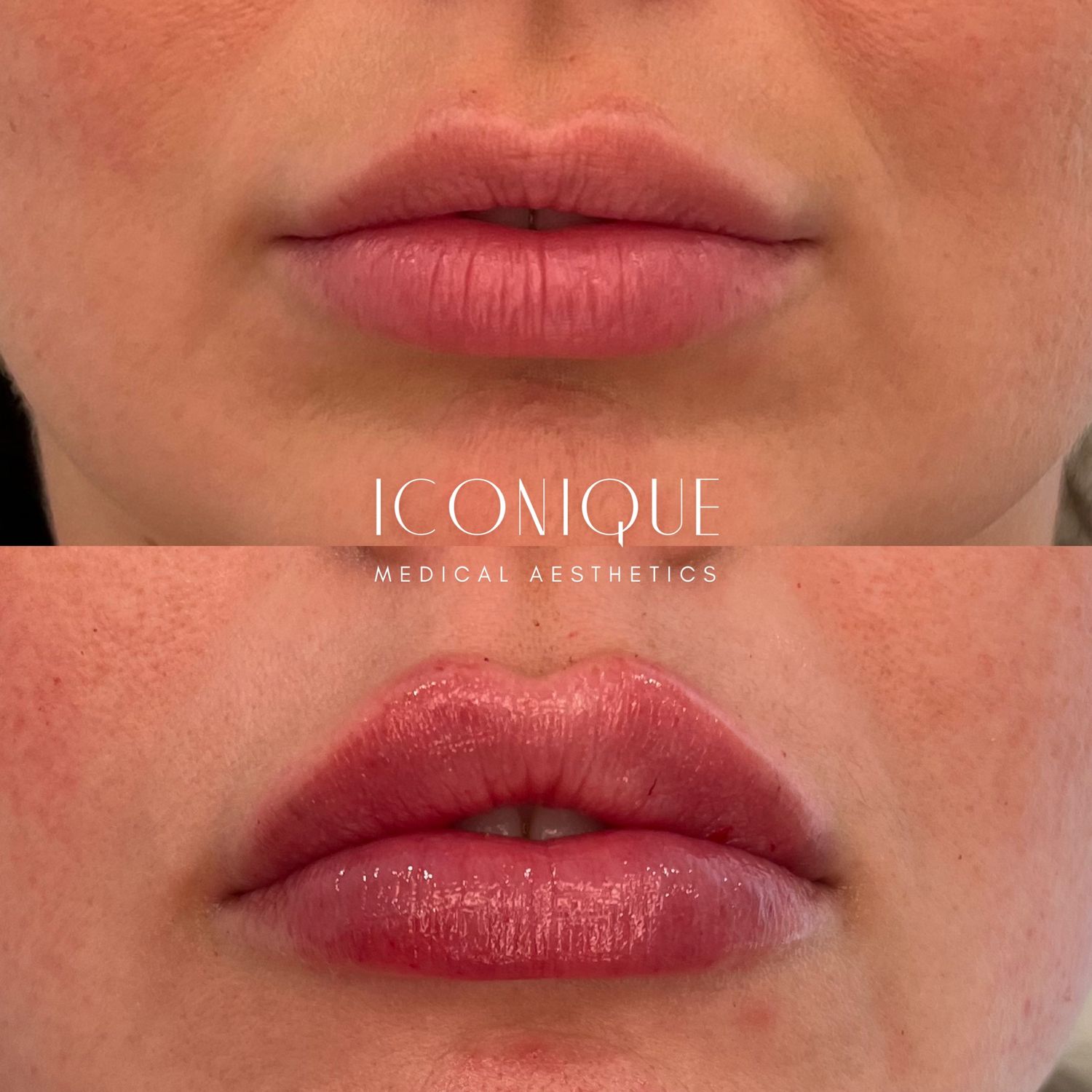Lip Filler Before & After