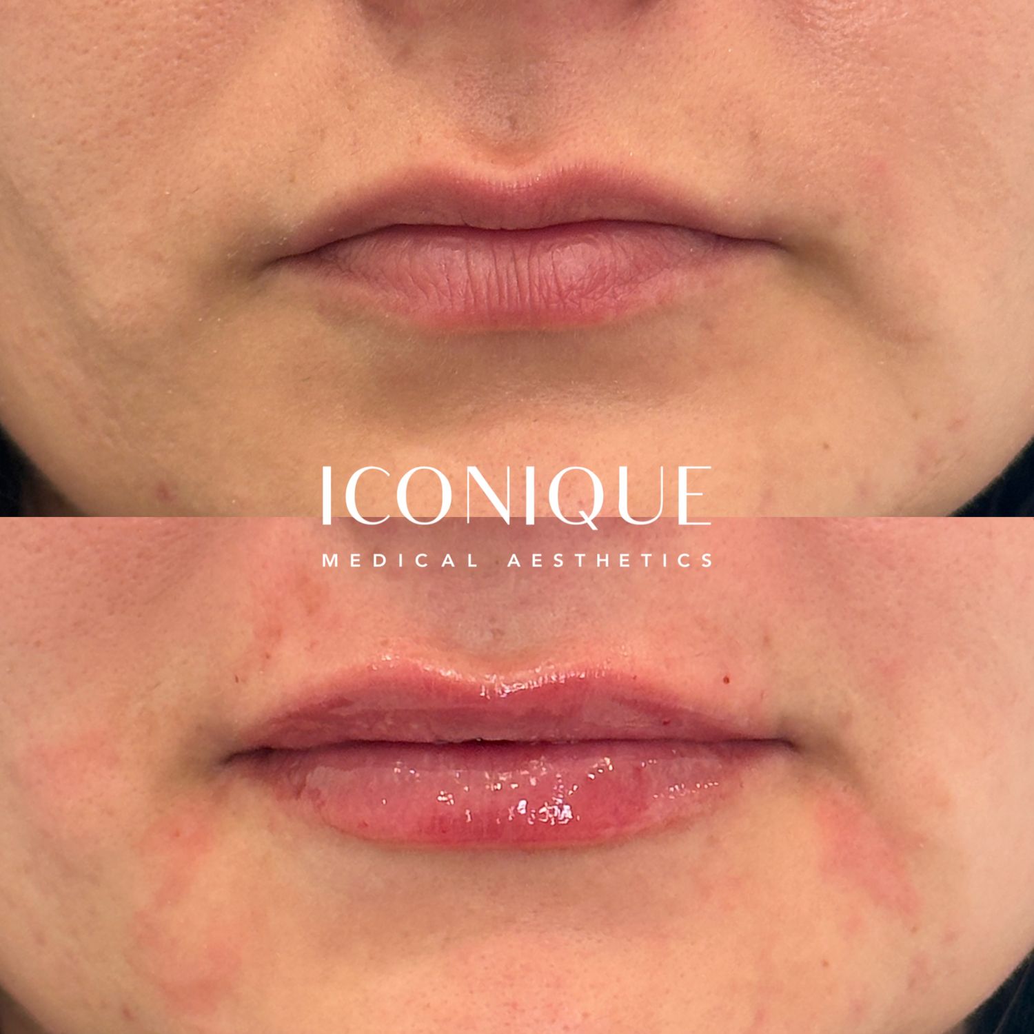 Lip Filler Before & After