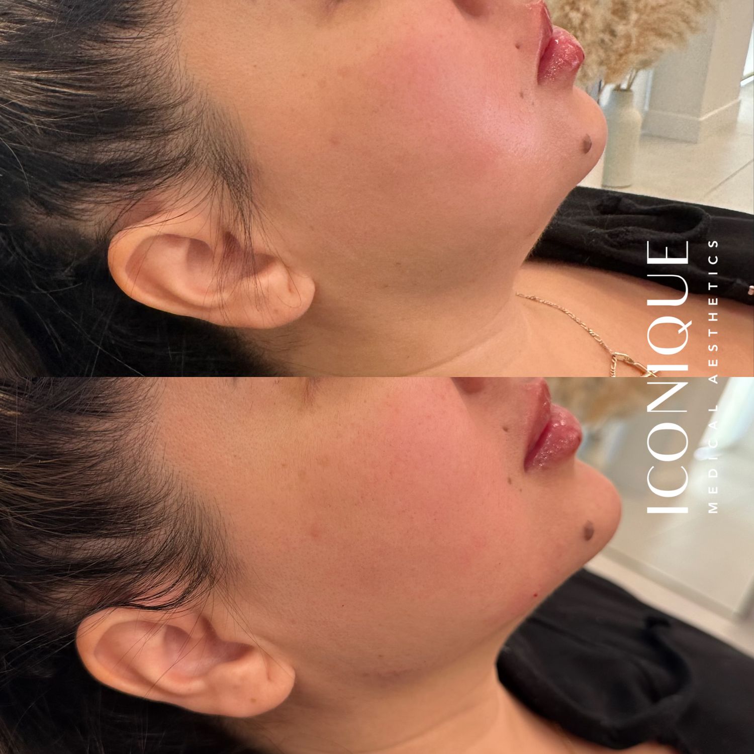 Jawline Filler Before & After