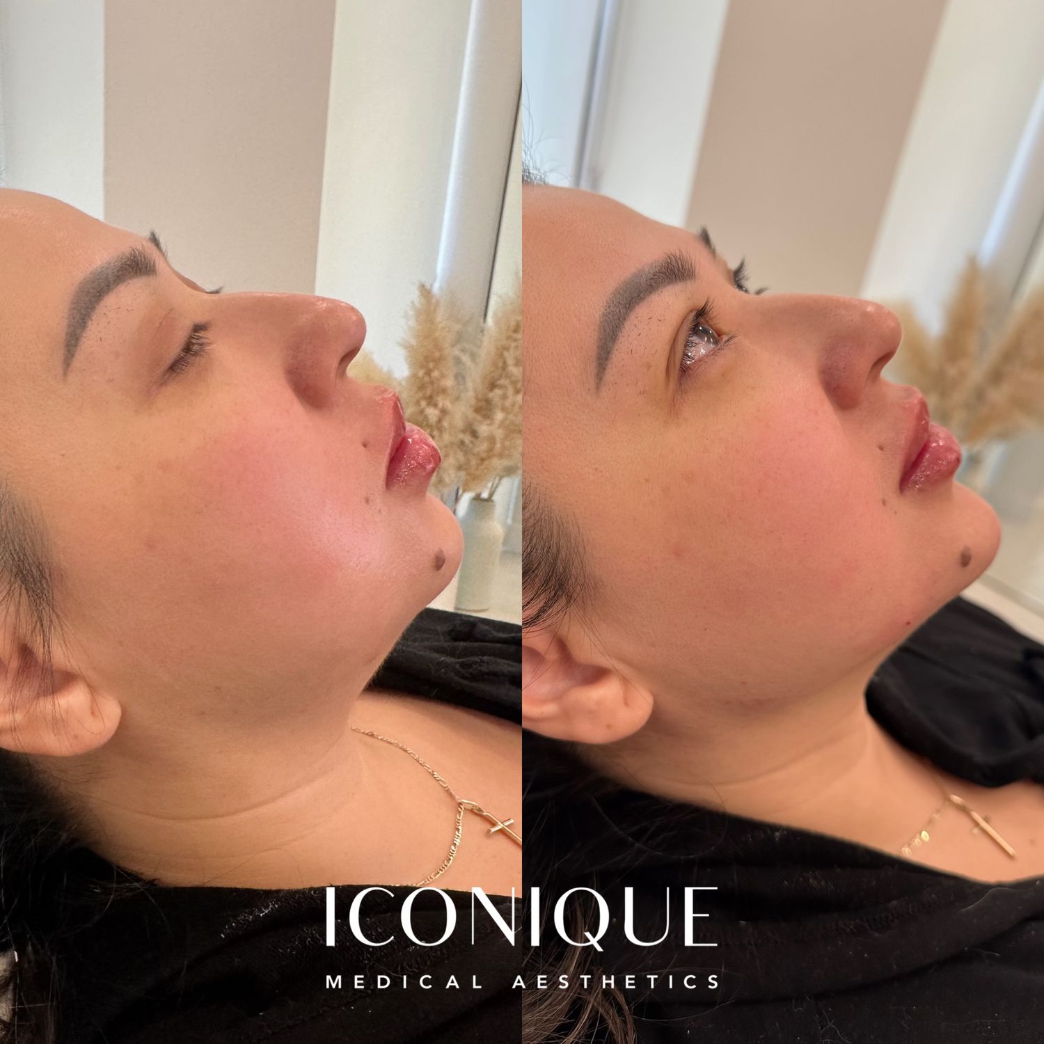 Jawline Filler Before & After