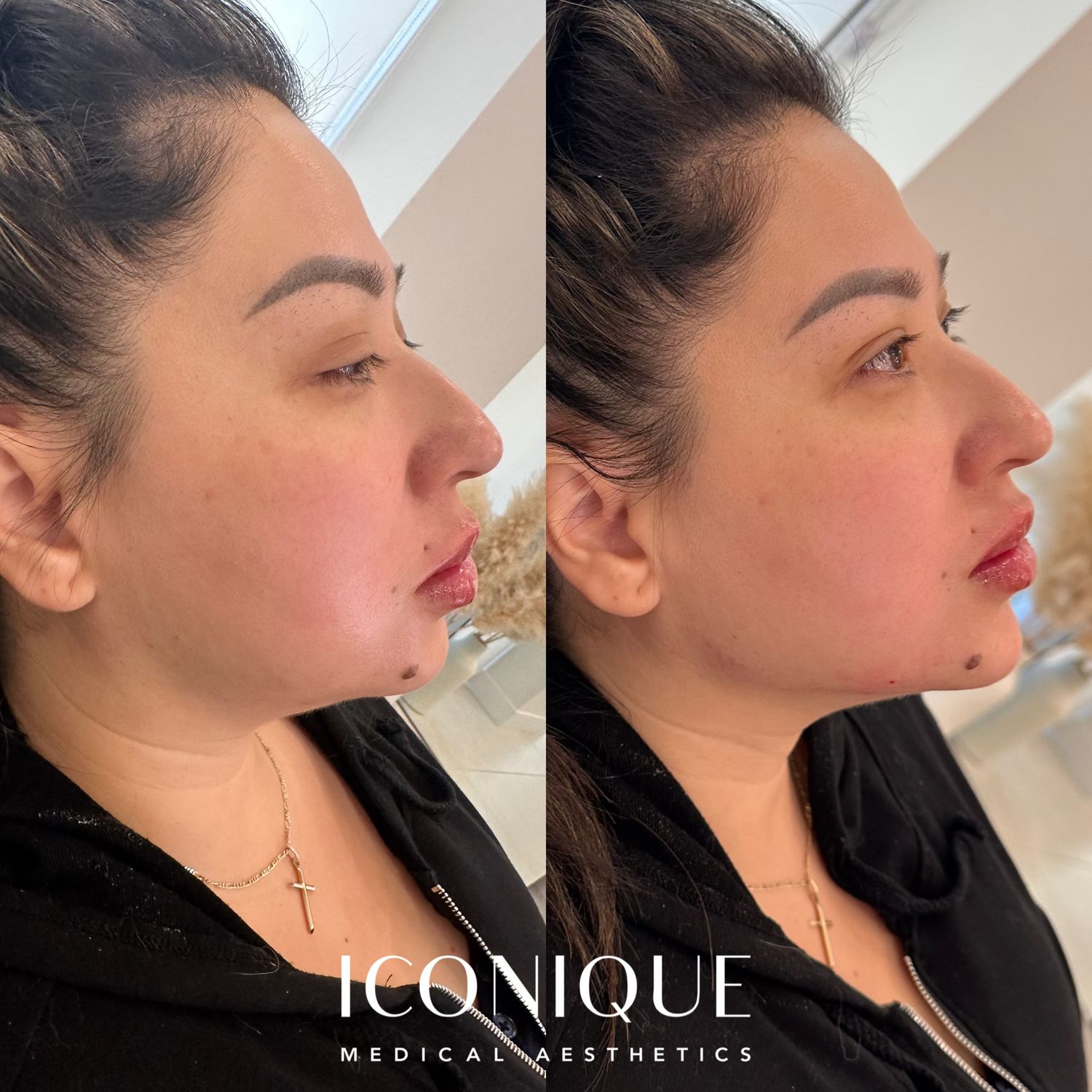 Jawline Filler Before & After