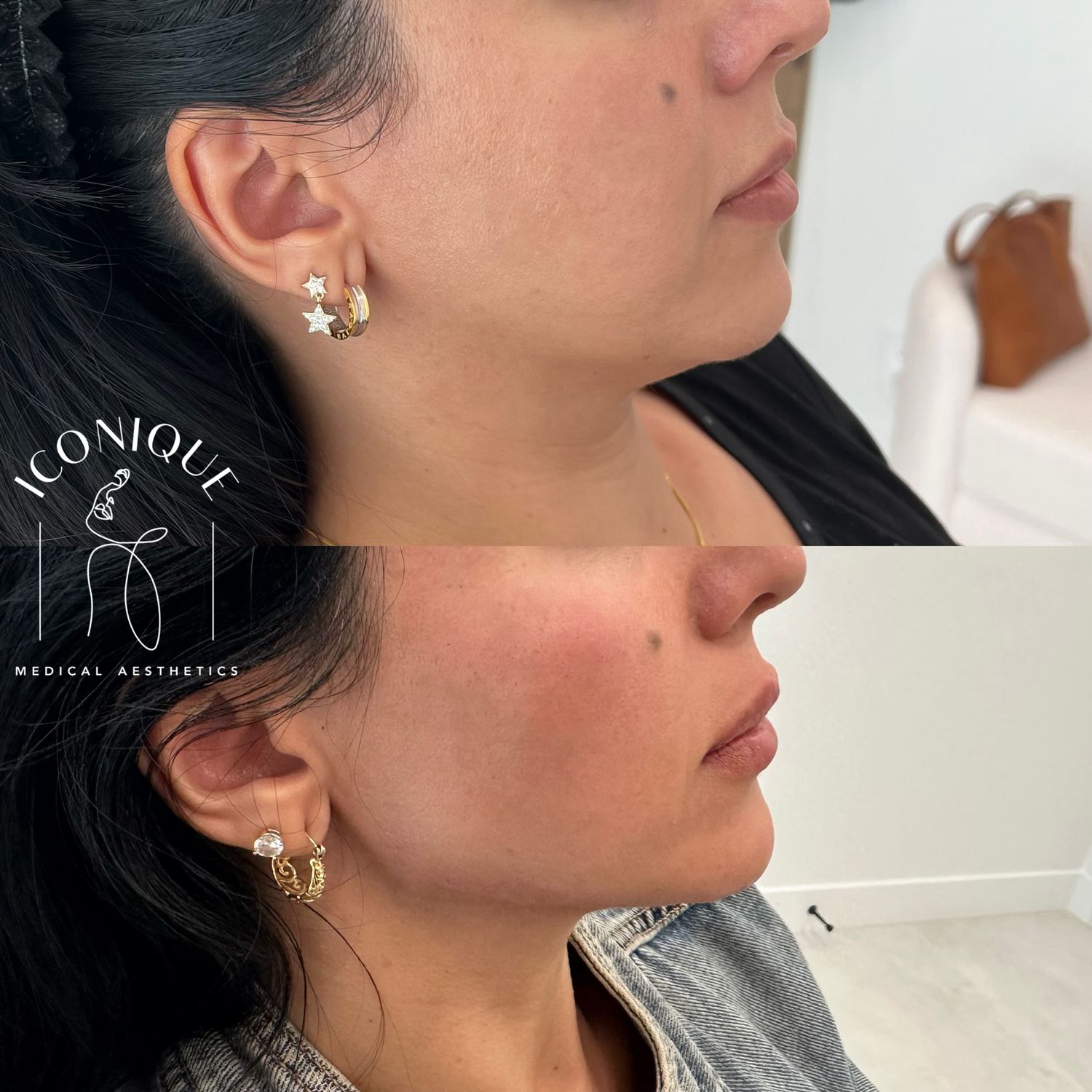 Jawline Filler Before & After