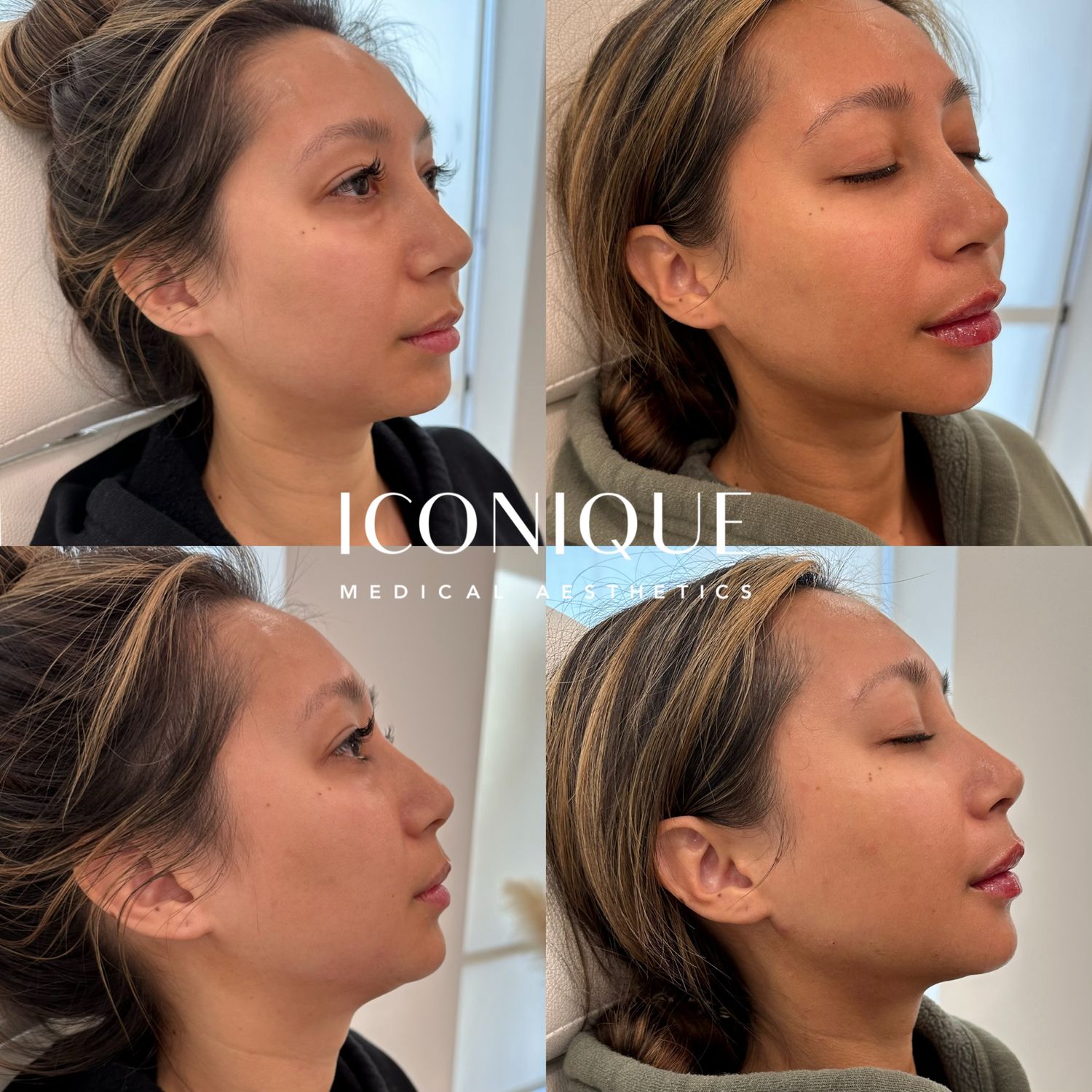 Jawline Filler Before & After