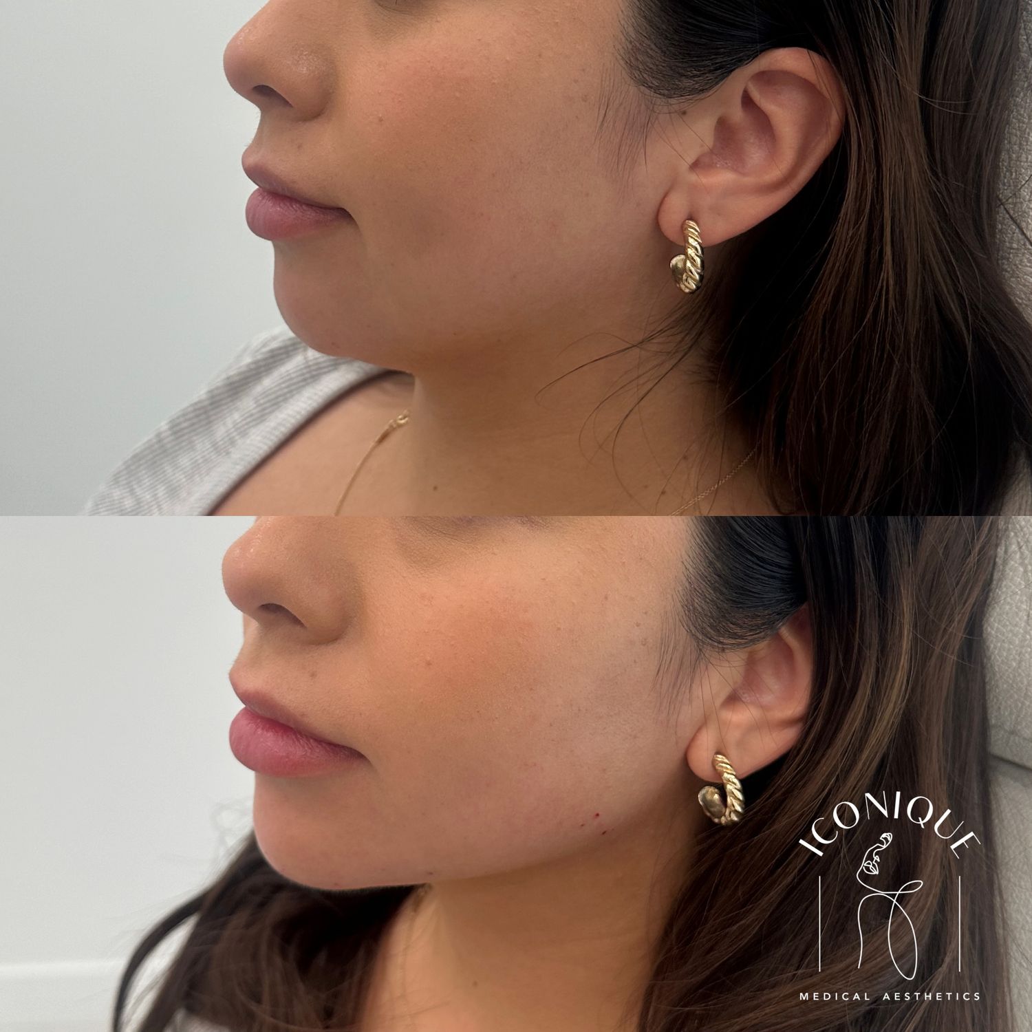 Jawline Filler Before & After