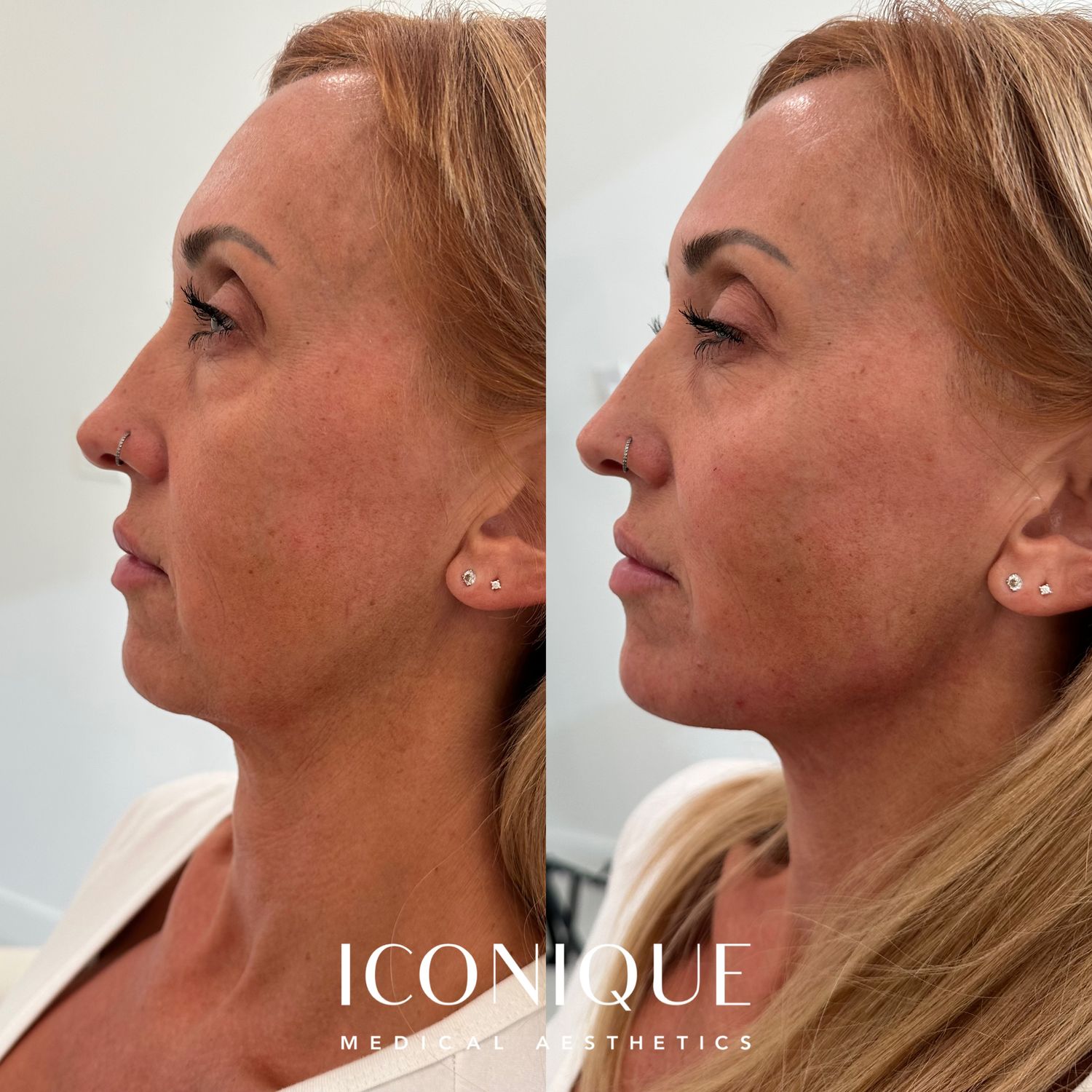 Jawline Filler Before & After