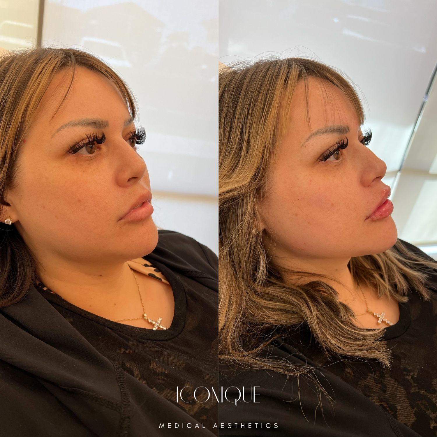 Jawline Filler Before & After