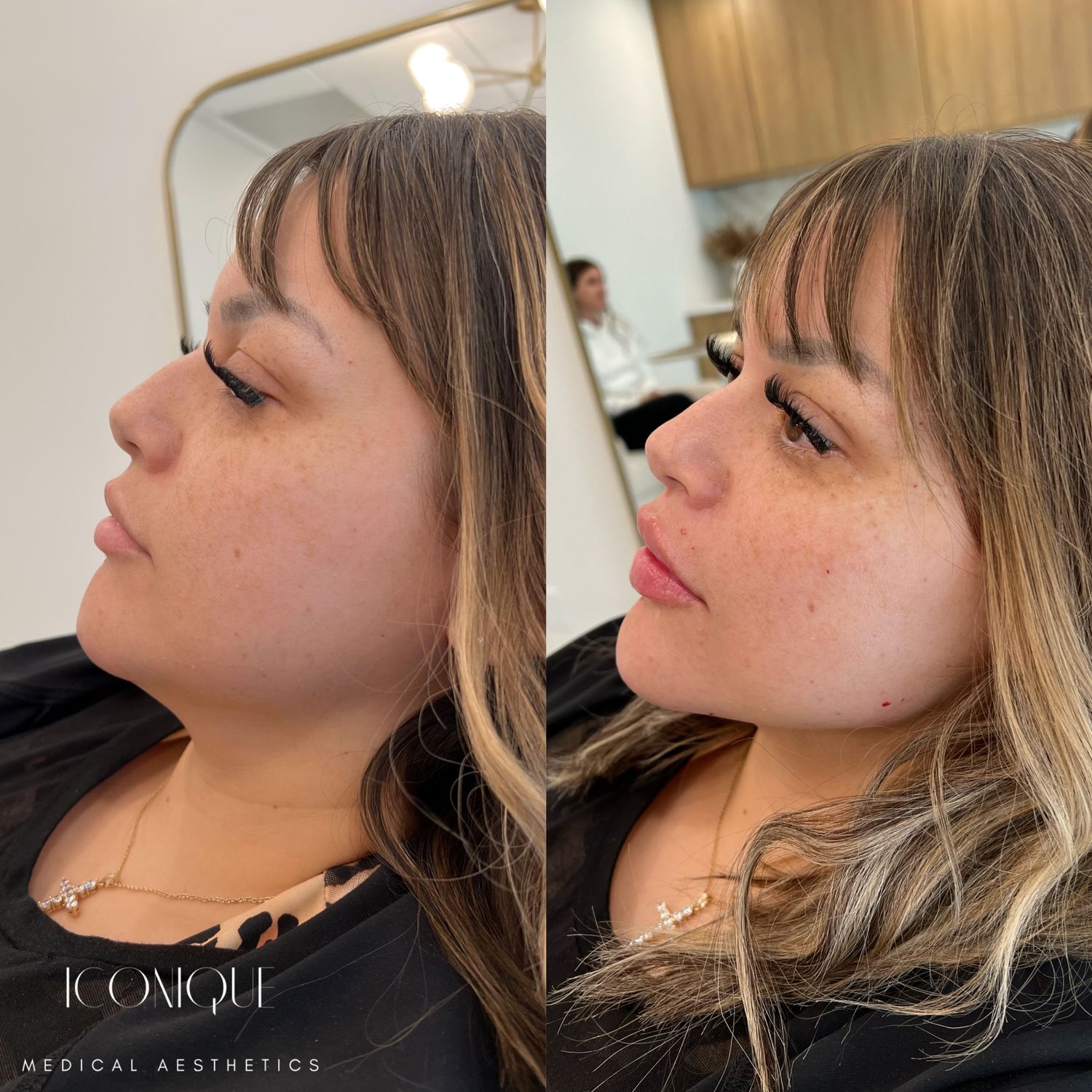 Jawline Filler Before & After