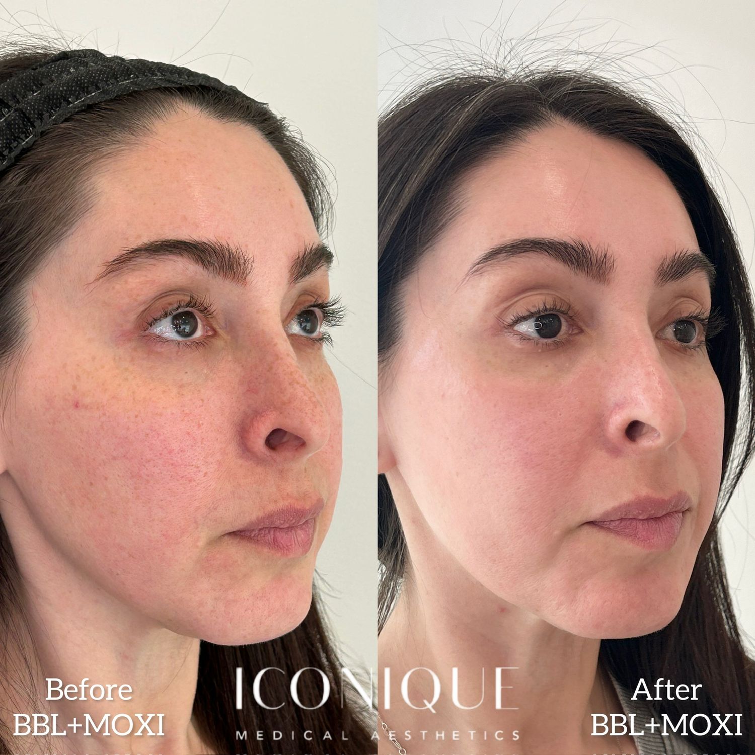 Laser Treatment Before & After